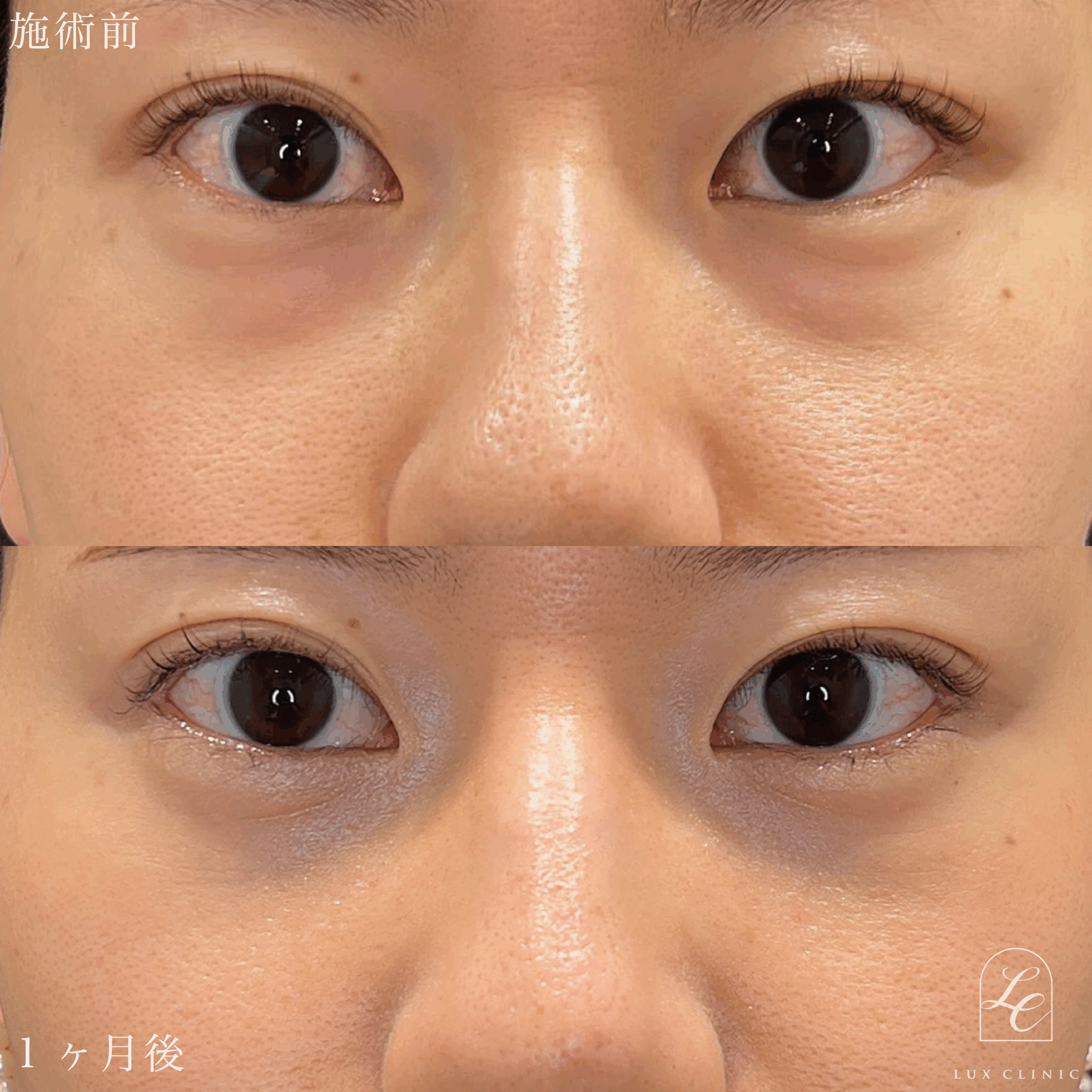 目の下のクマ取り、ふくらみ取り（脱脂）術