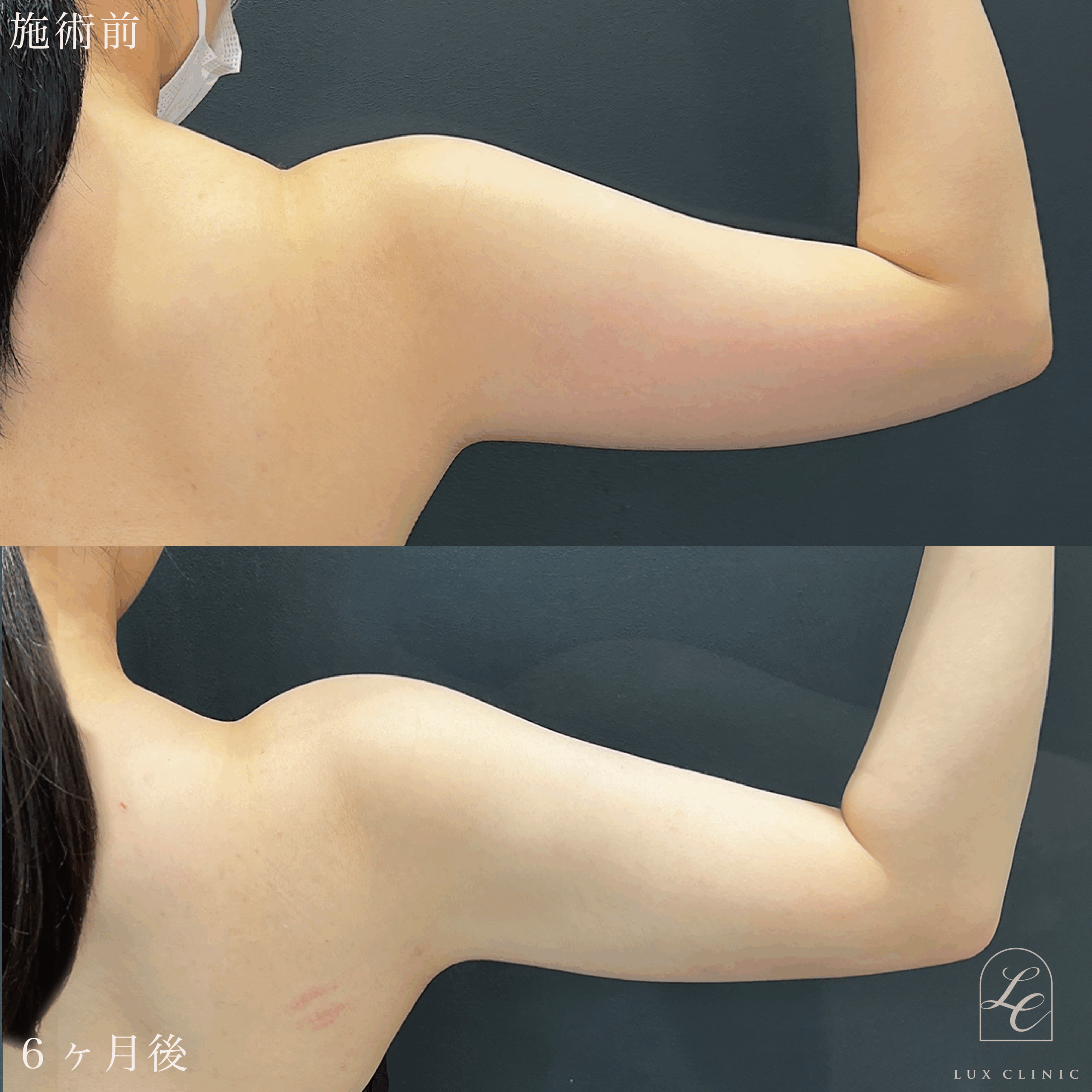 Ultra-Z 脂肪吸引 ＜二の腕（後面）・肩・肩甲骨横＞