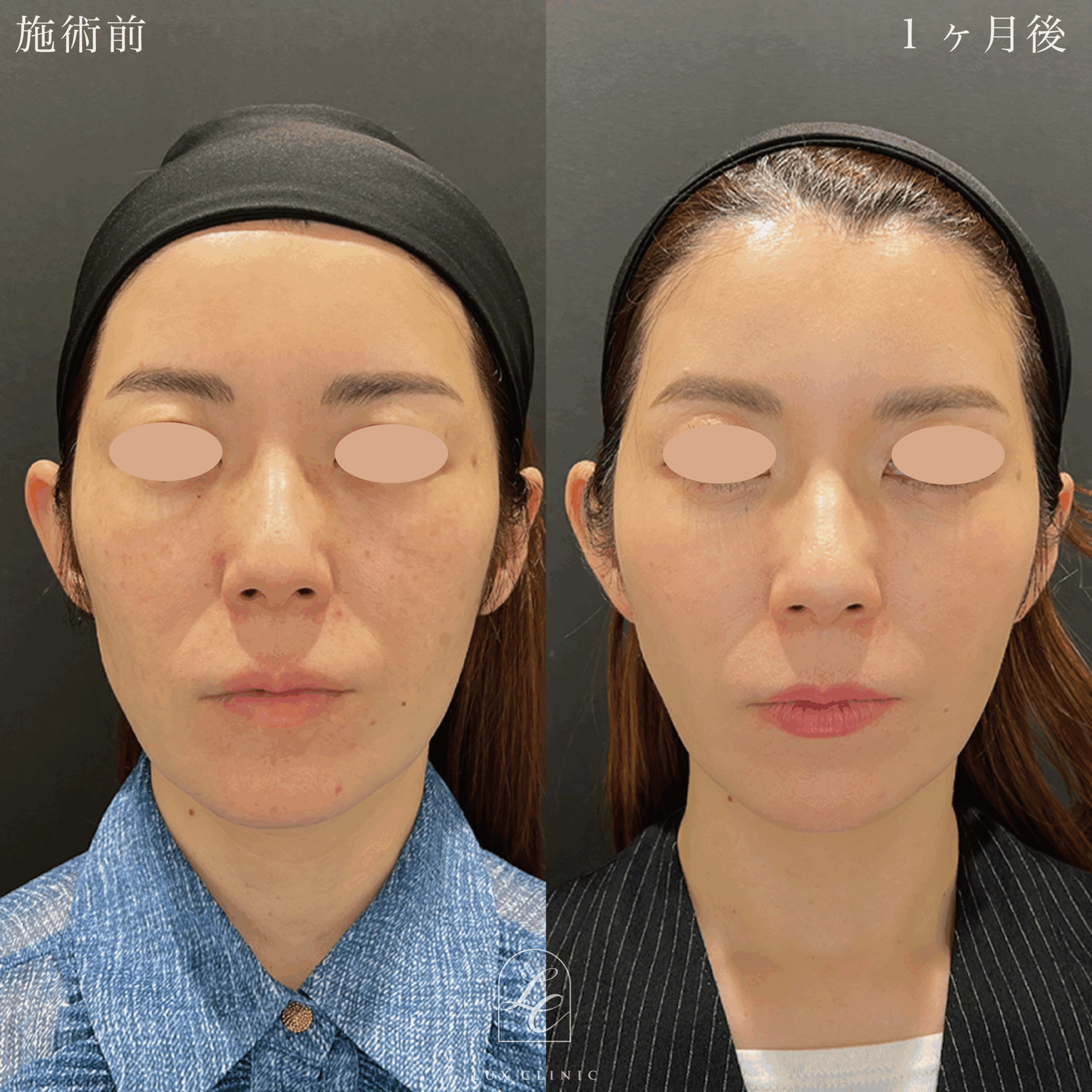 ミニフェイスリフト ＋ 糸リフト 10本