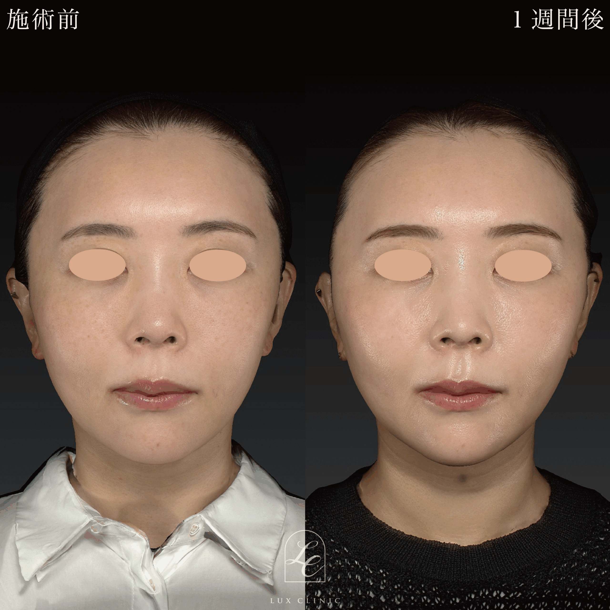 糸リフト（テスリフト 10本）