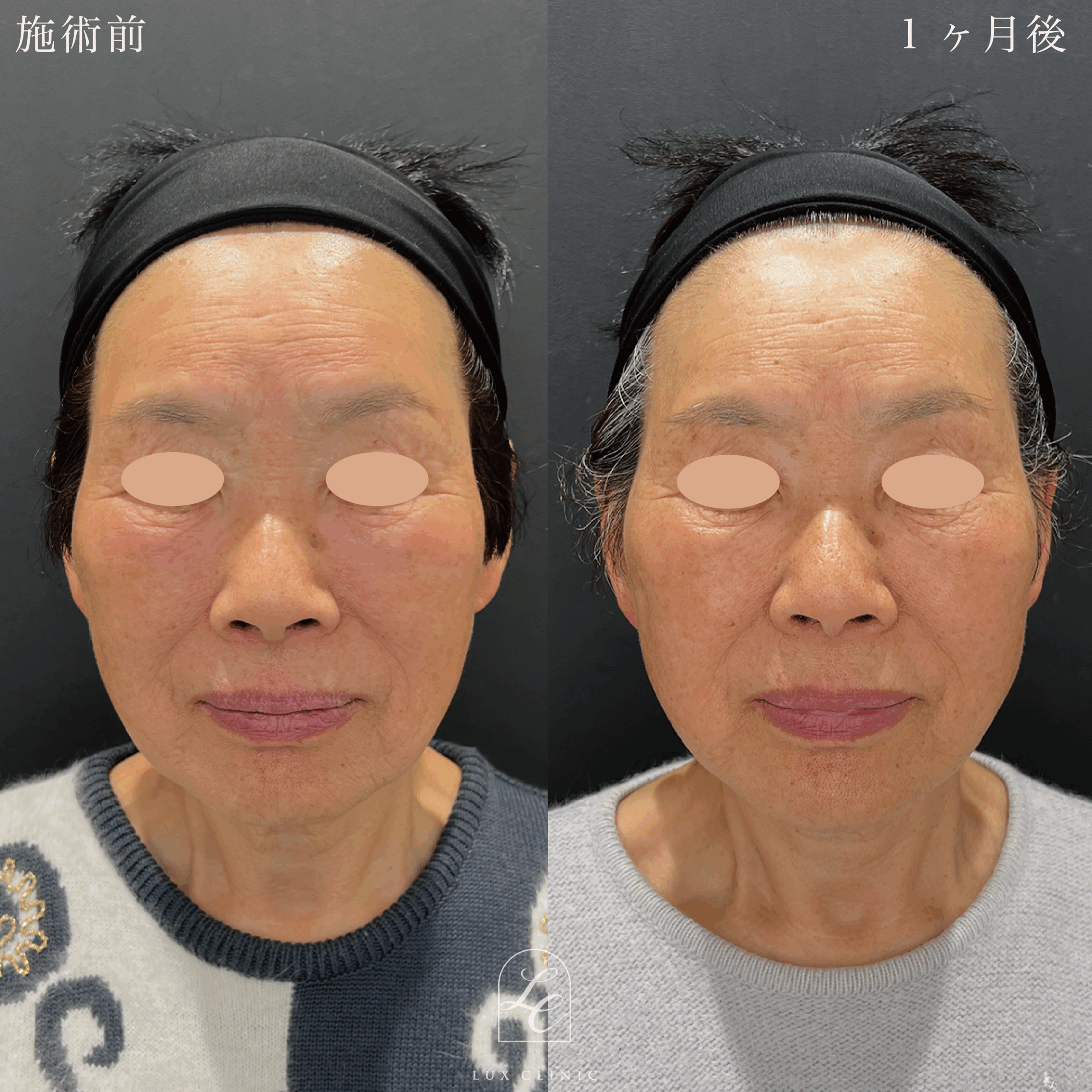 ミニフェイスリフト ＋ 糸リフト 10本