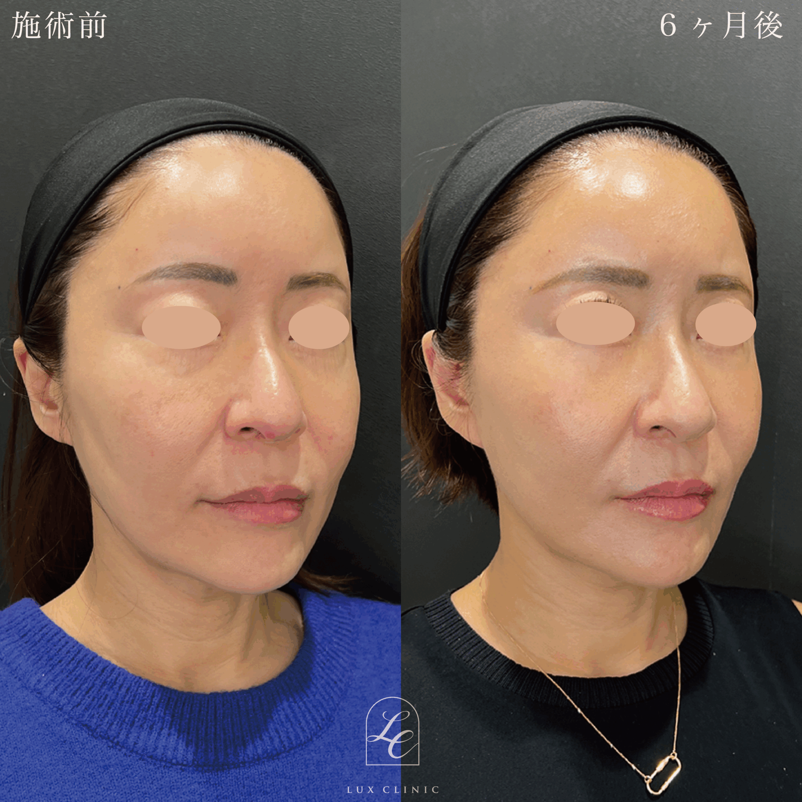 ミニフェイスリフト ＋ 糸リフト 10本