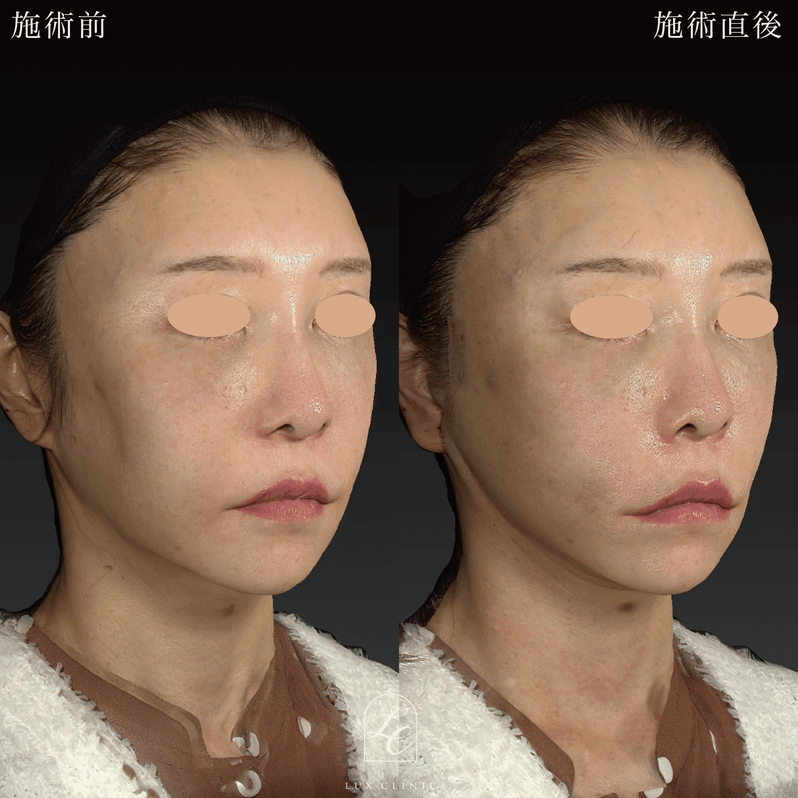 ミニフェイスリフト ＋ 糸リフト 10本