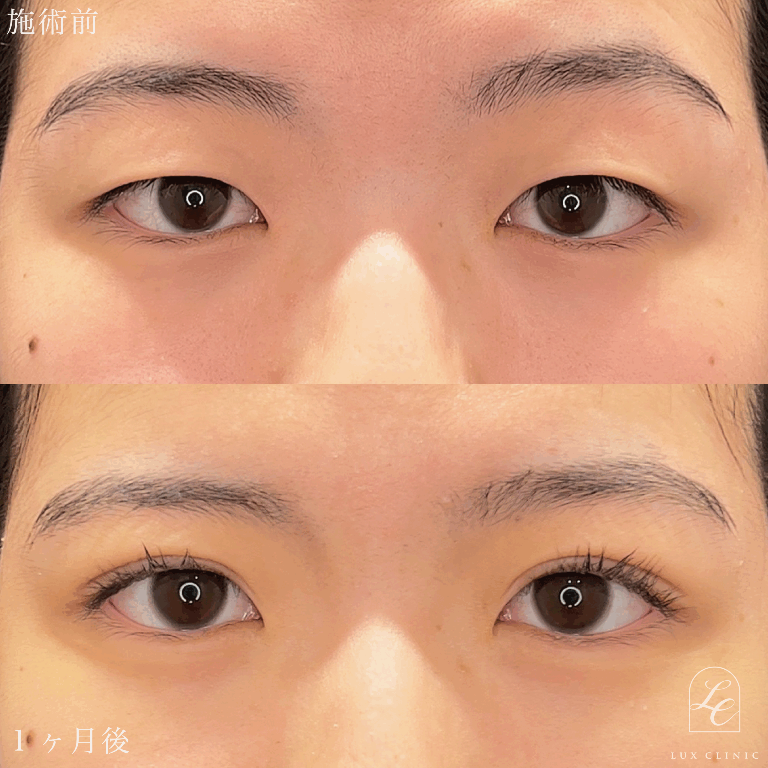 二重埋没法（クイックベーシック法 3点留め）