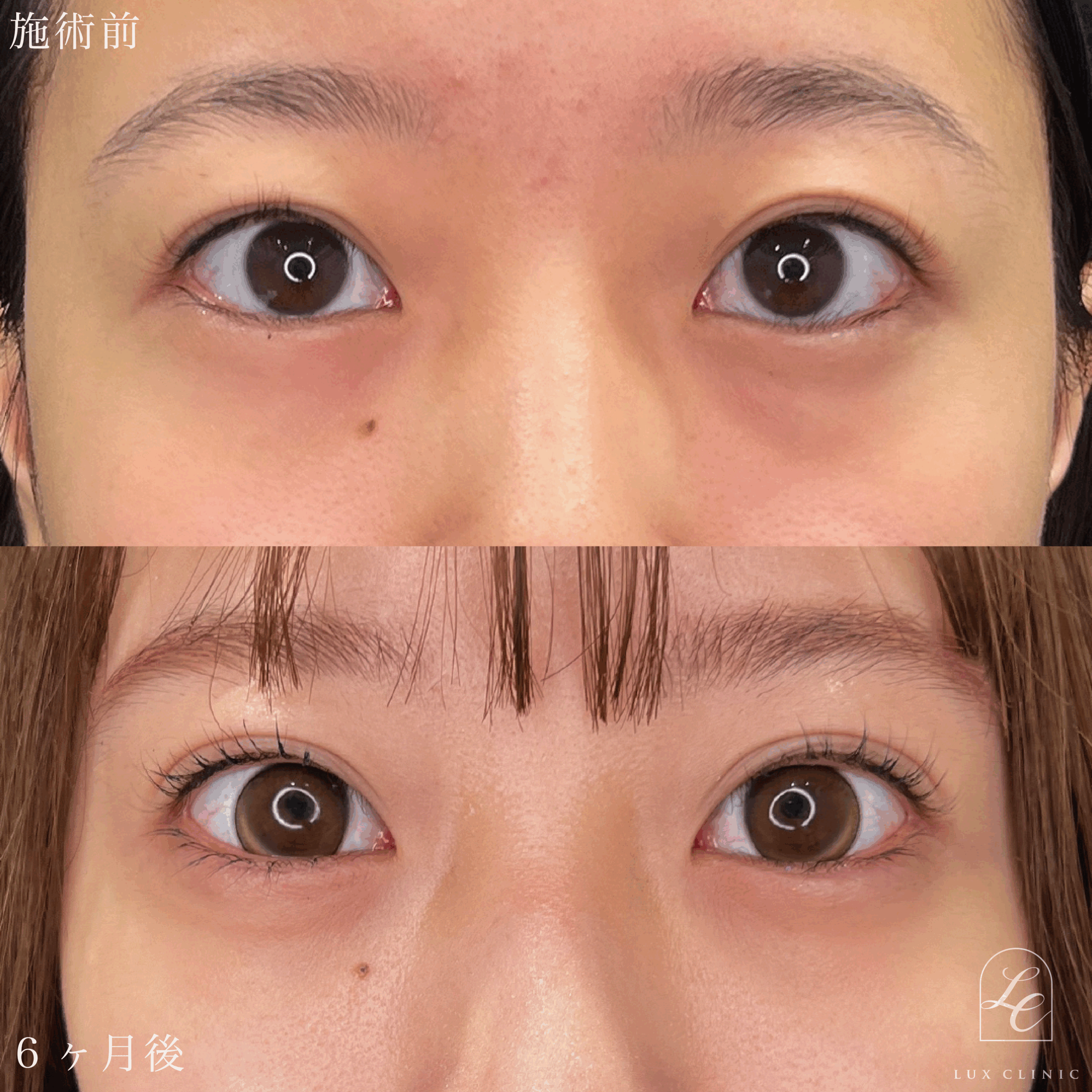 二重埋没法（クイックベーシック法 3点留め） ＋ 目の下のクマ取り、ふくらみ取り（脱脂）術