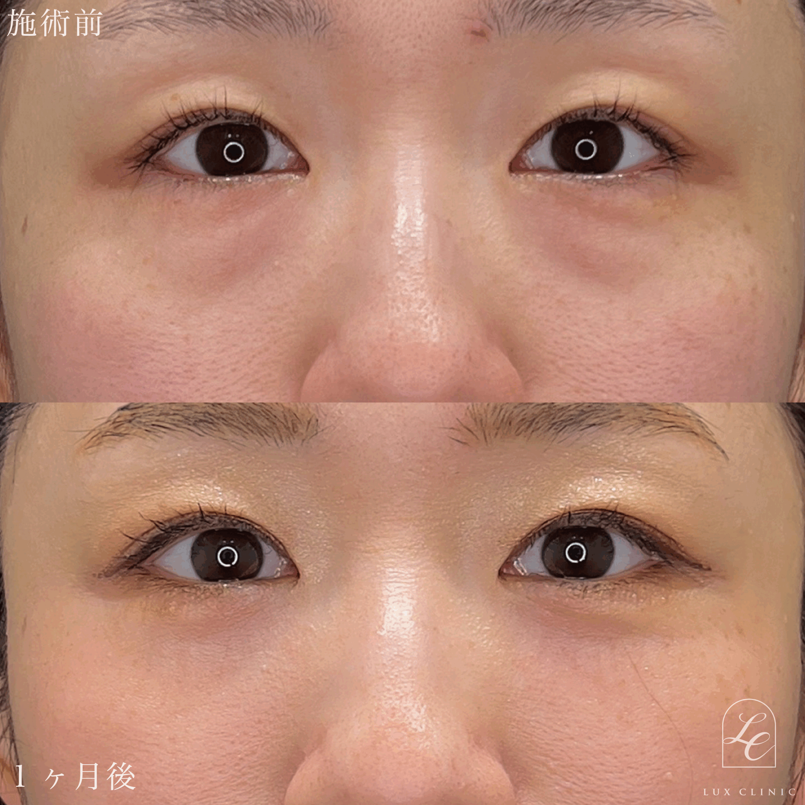 目の下のクマ取り、ふくらみ取り（脱脂）術 ＋ 二重埋没法（クイックベーシック法 2点留め）