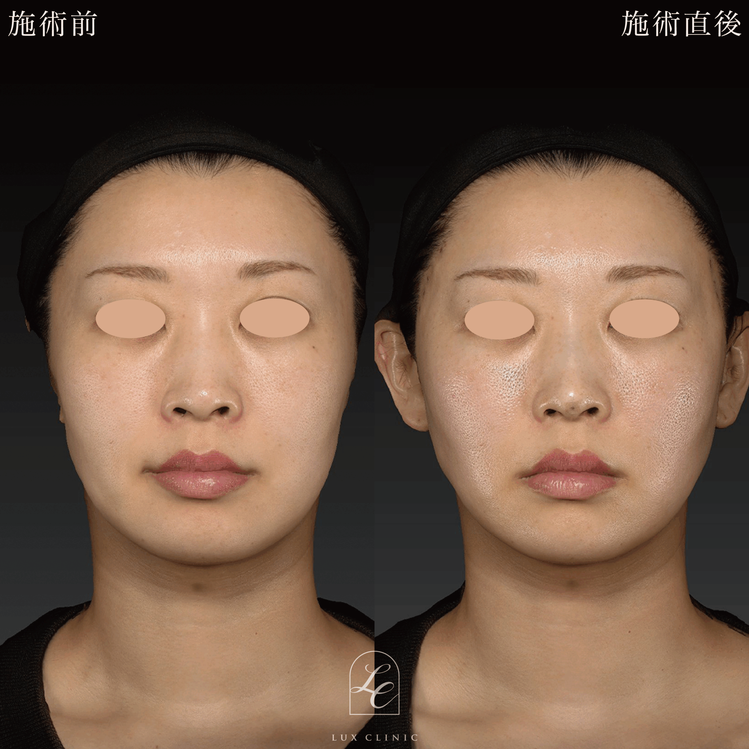 糸リフト（テスリフト 10本）