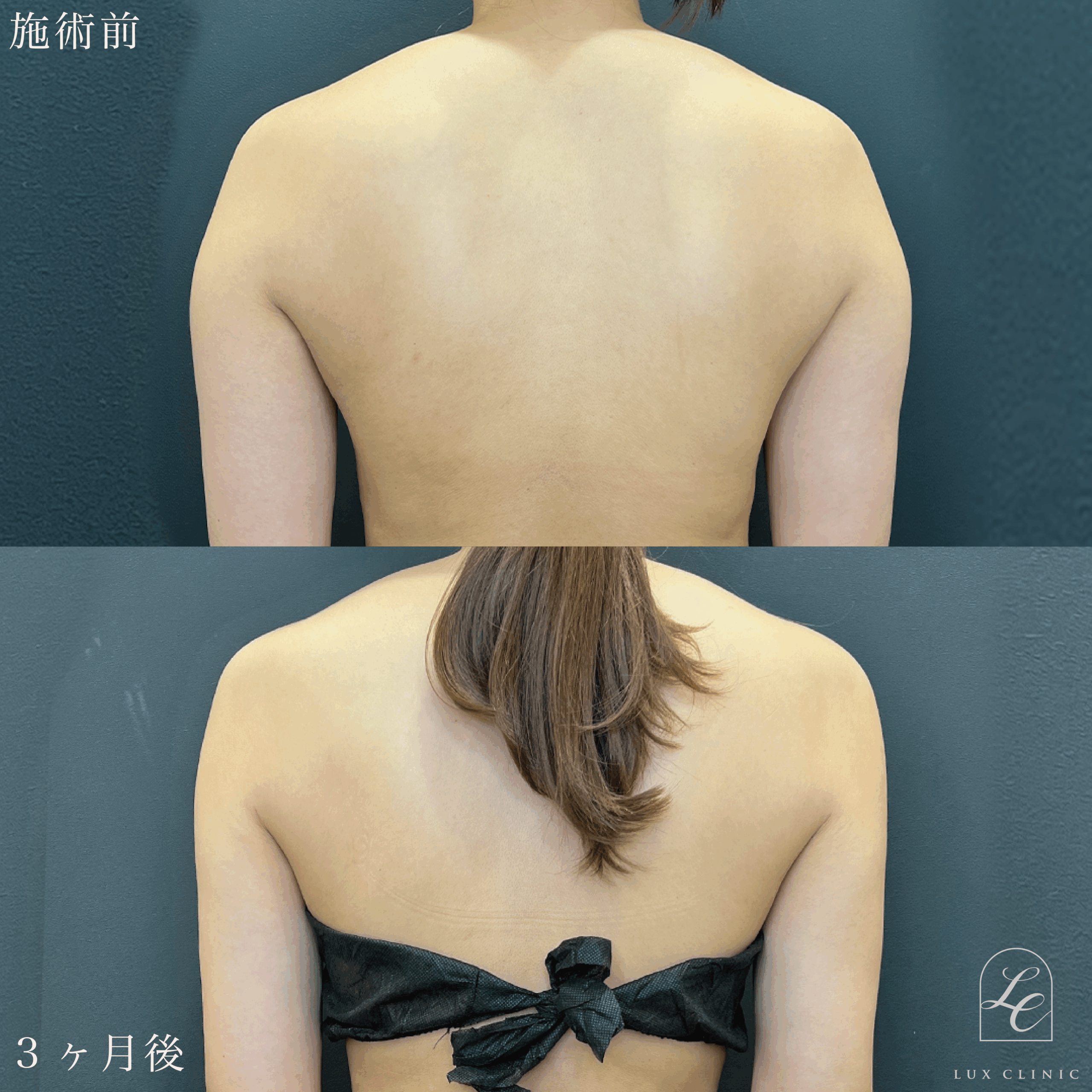 Ultra-Z 脂肪吸引 ＜二の腕（後面）・肩・ブラ上＞