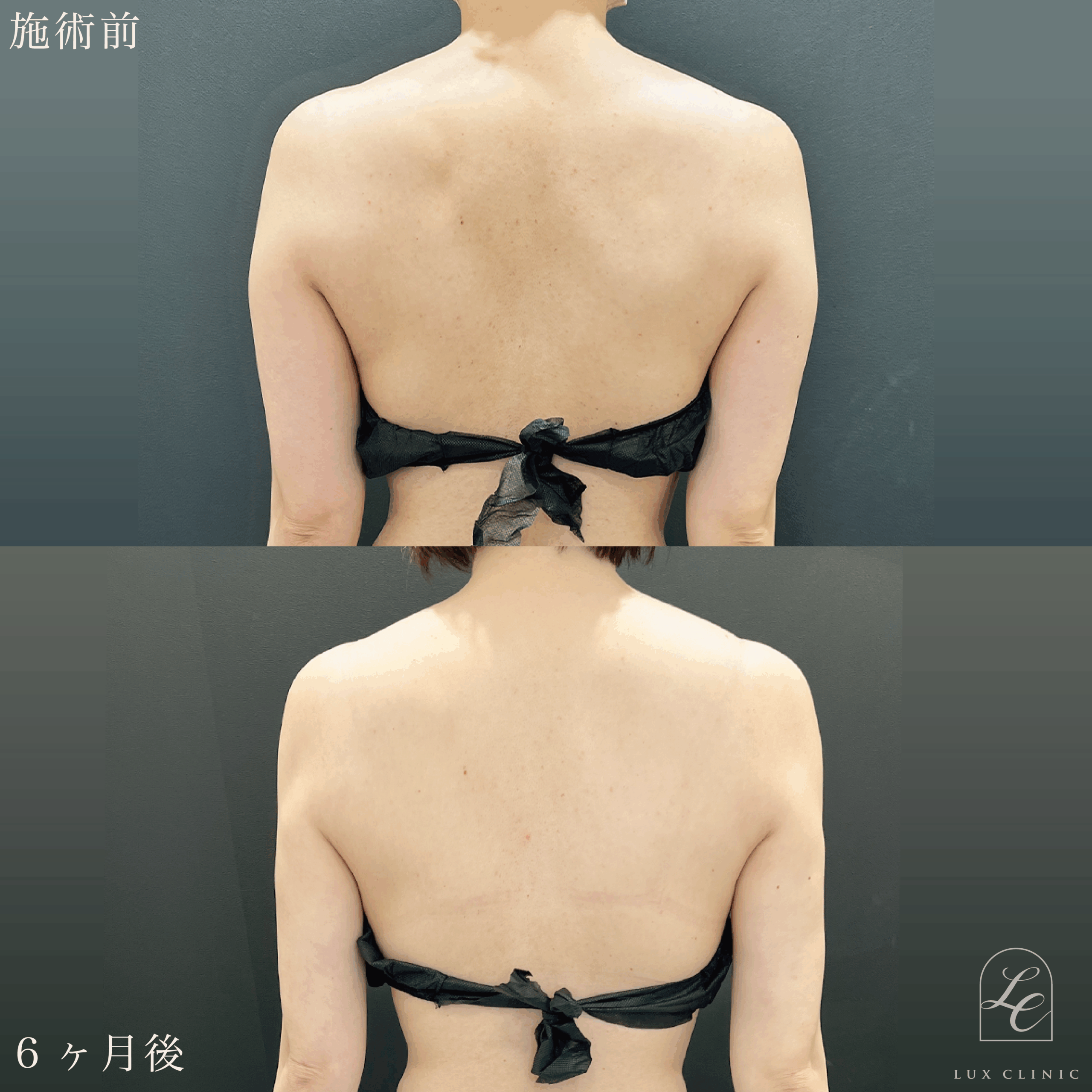 Ultra-Z 脂肪吸引 ＜二の腕（後面）・肩・肩甲骨横＞