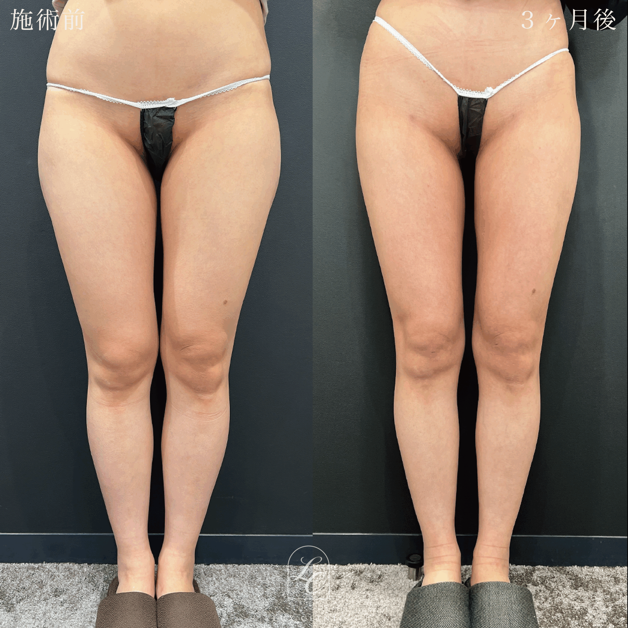 Ultra-Z 脂肪吸引 ＜大腿（全周）・臀部・膝＞