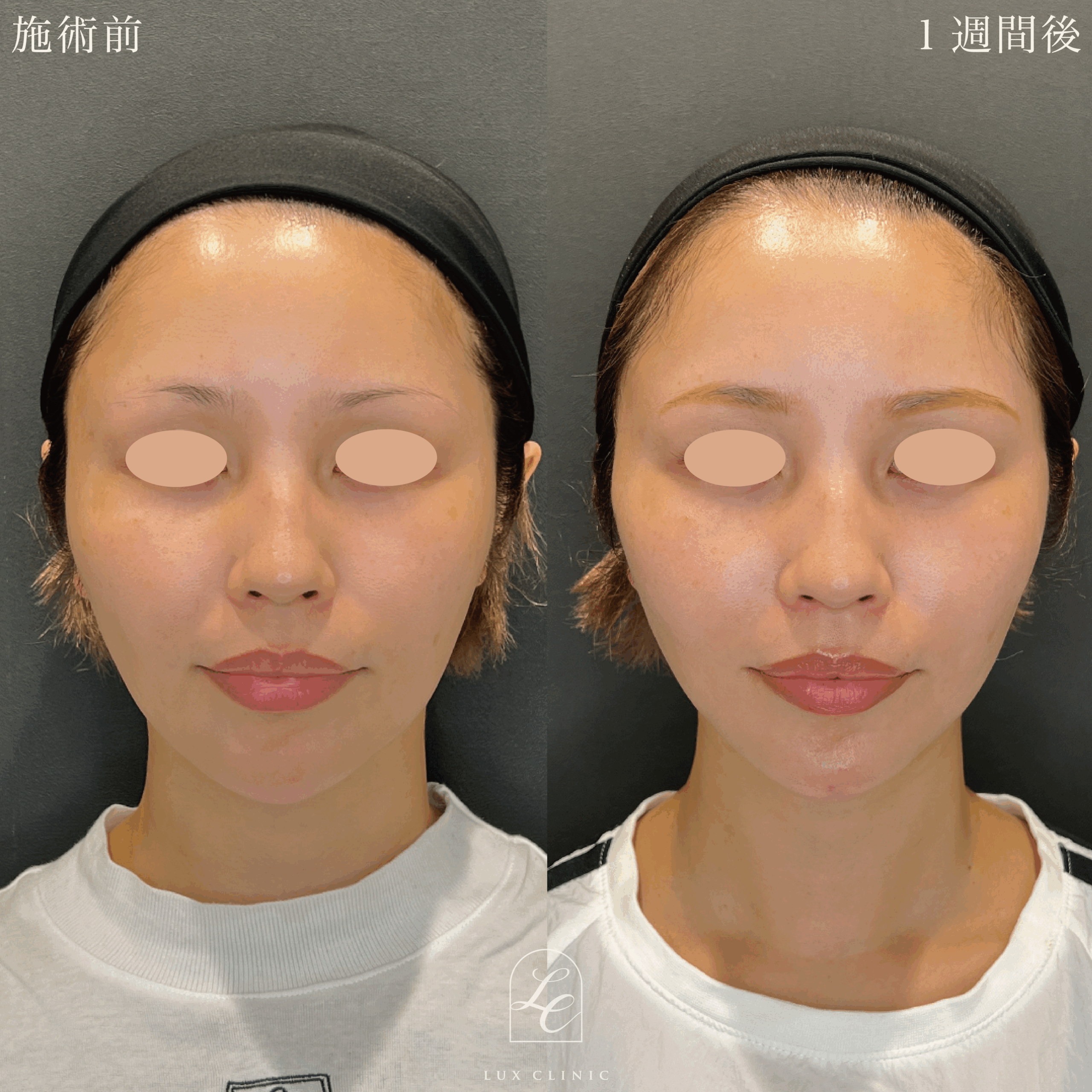 糸リフト（テスリフト 4本・BNLS Ultimate Lifting 2本）