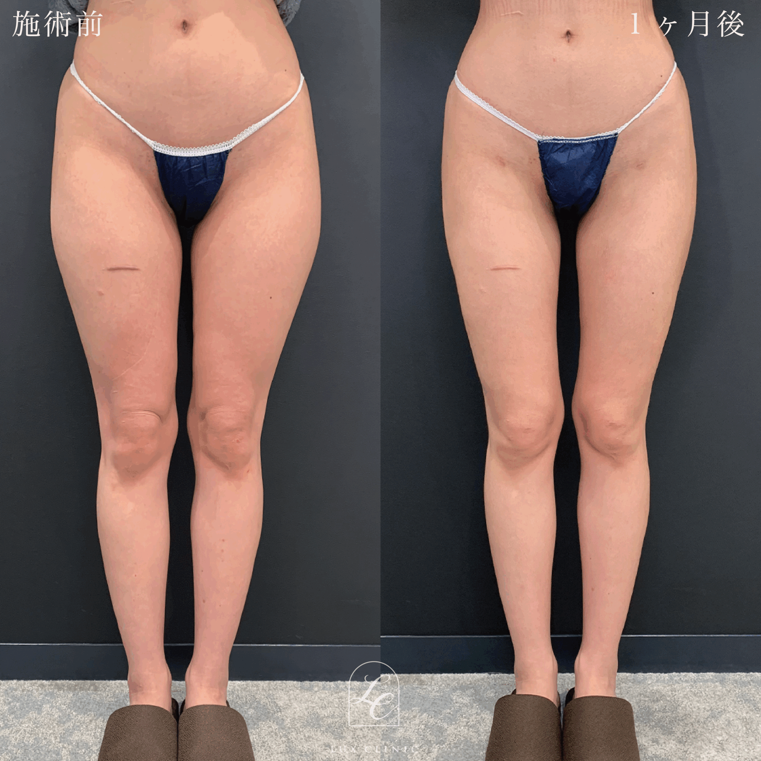 Ultra-Z 脂肪吸引 ＜大腿（内側・外側・前面）・膝＞