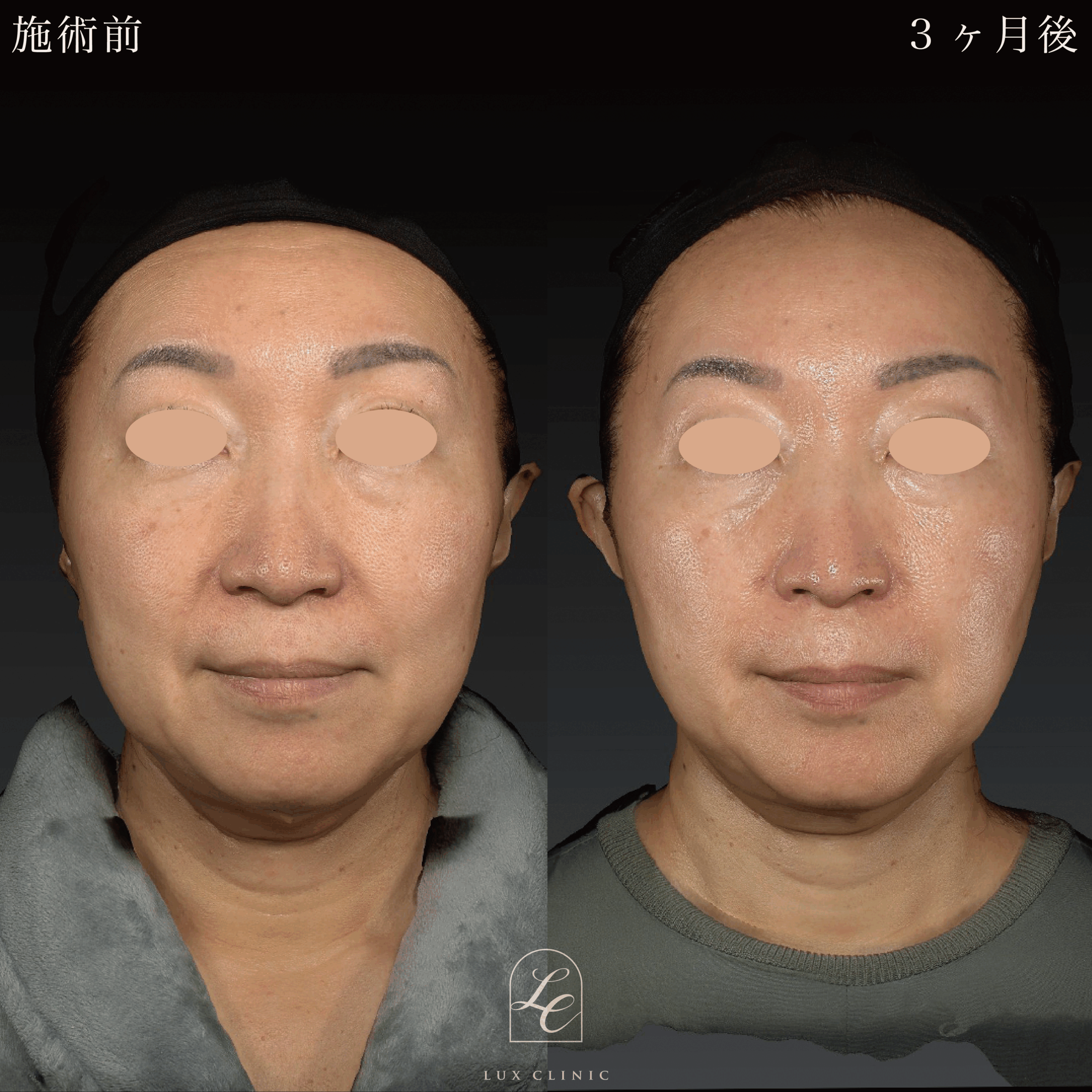 糸リフト（テスリフト 10本 ・ BNLS Ultimate Lifting 4本）