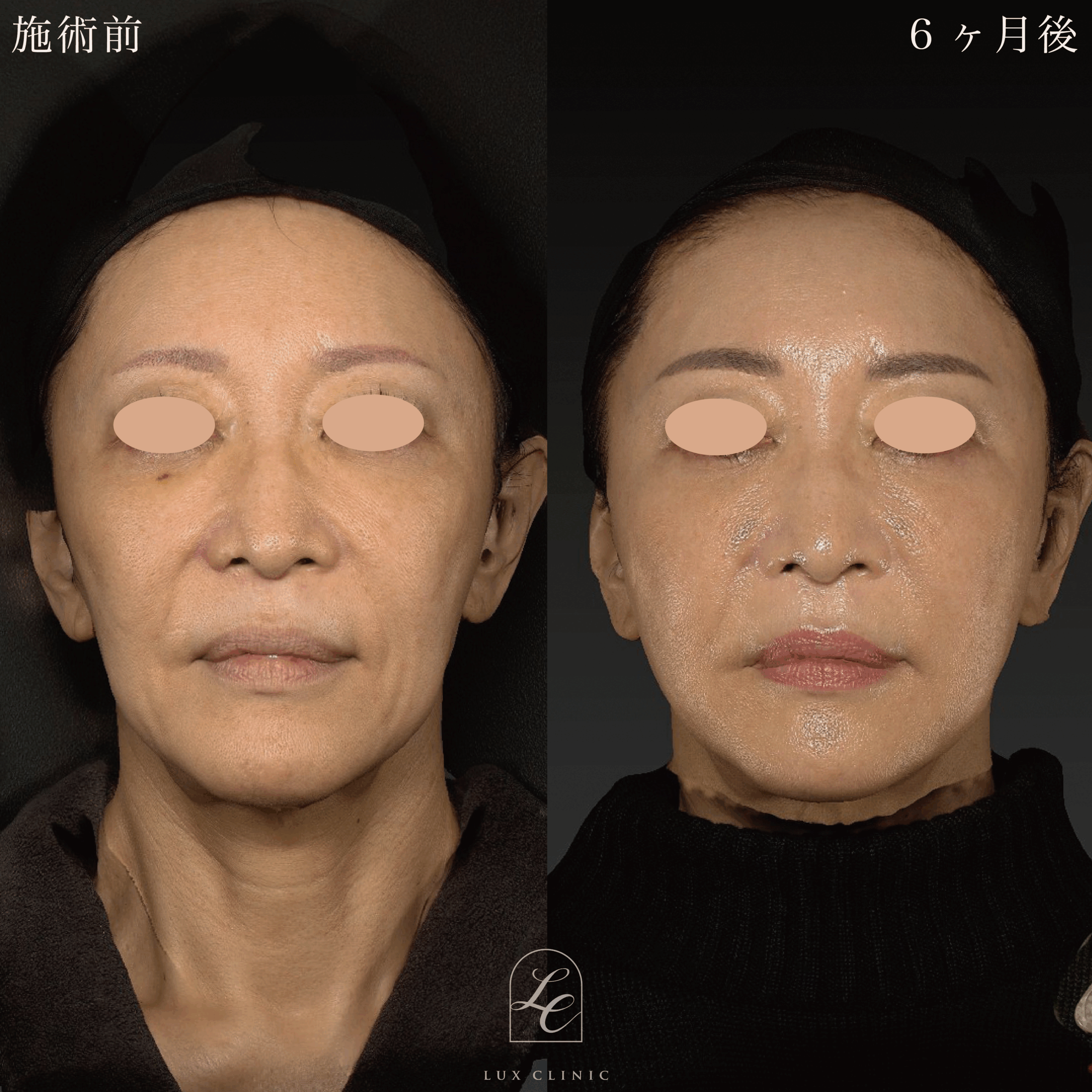 糸リフト（テスリフト 10本・BNLS Ultimate Lifting 6本）