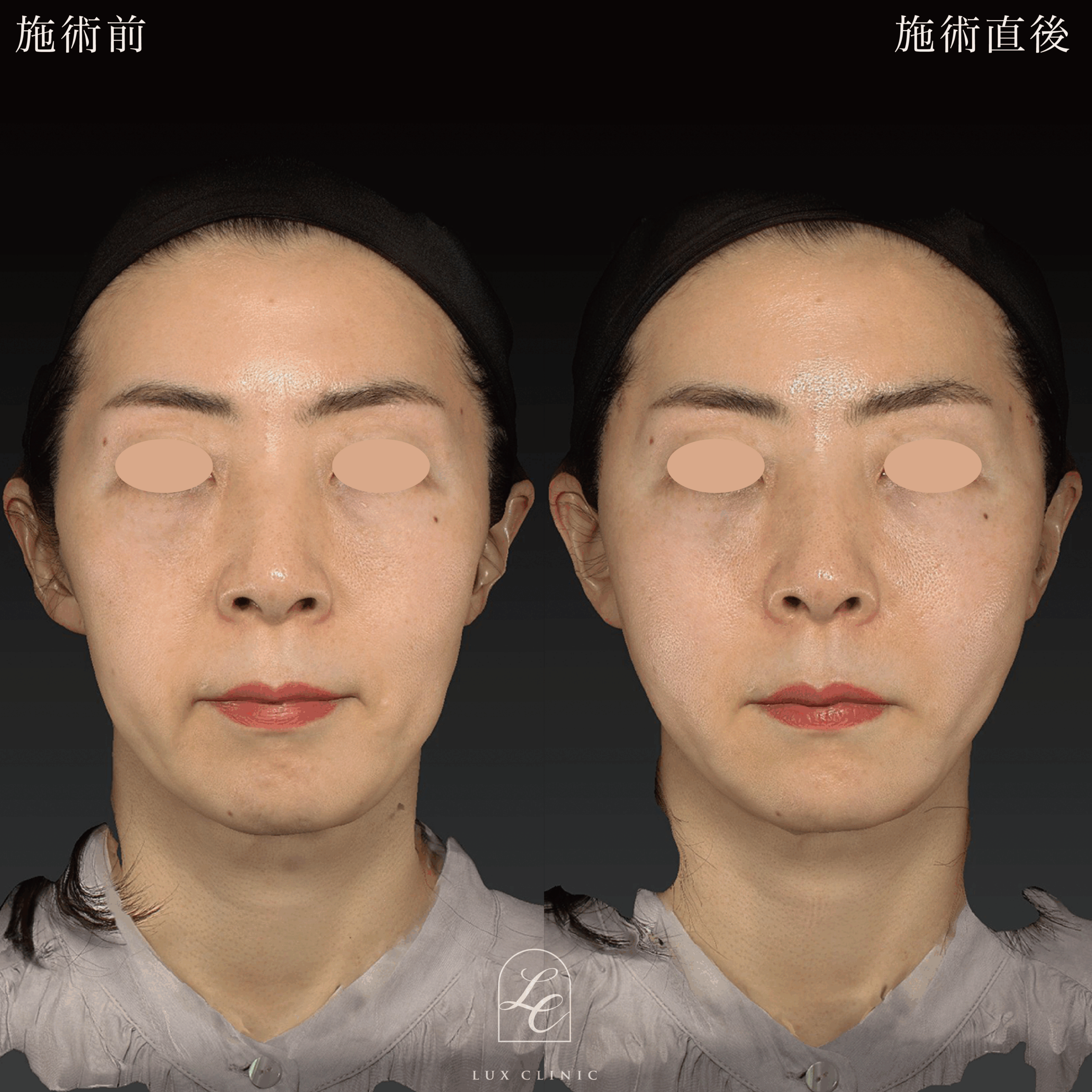 糸リフト（テスリフト 6本）＋ ヒアルロン酸（ニューラミス）2本 ＜鼻横・口横＞