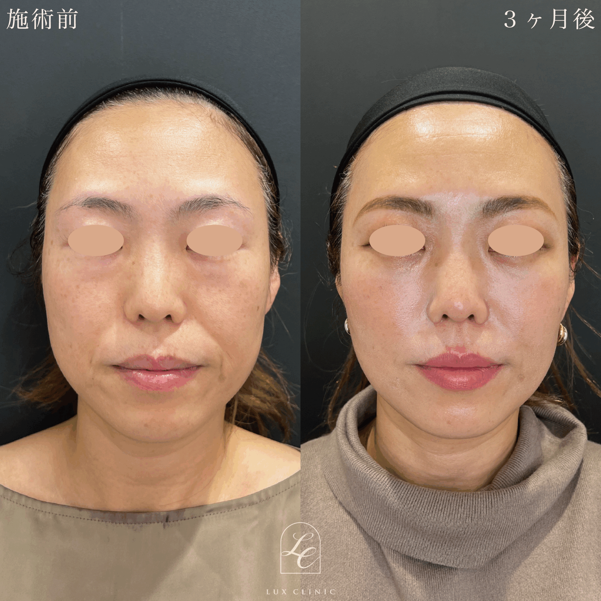 糸リフト（テスリフト 10本）＋ エラボトックス