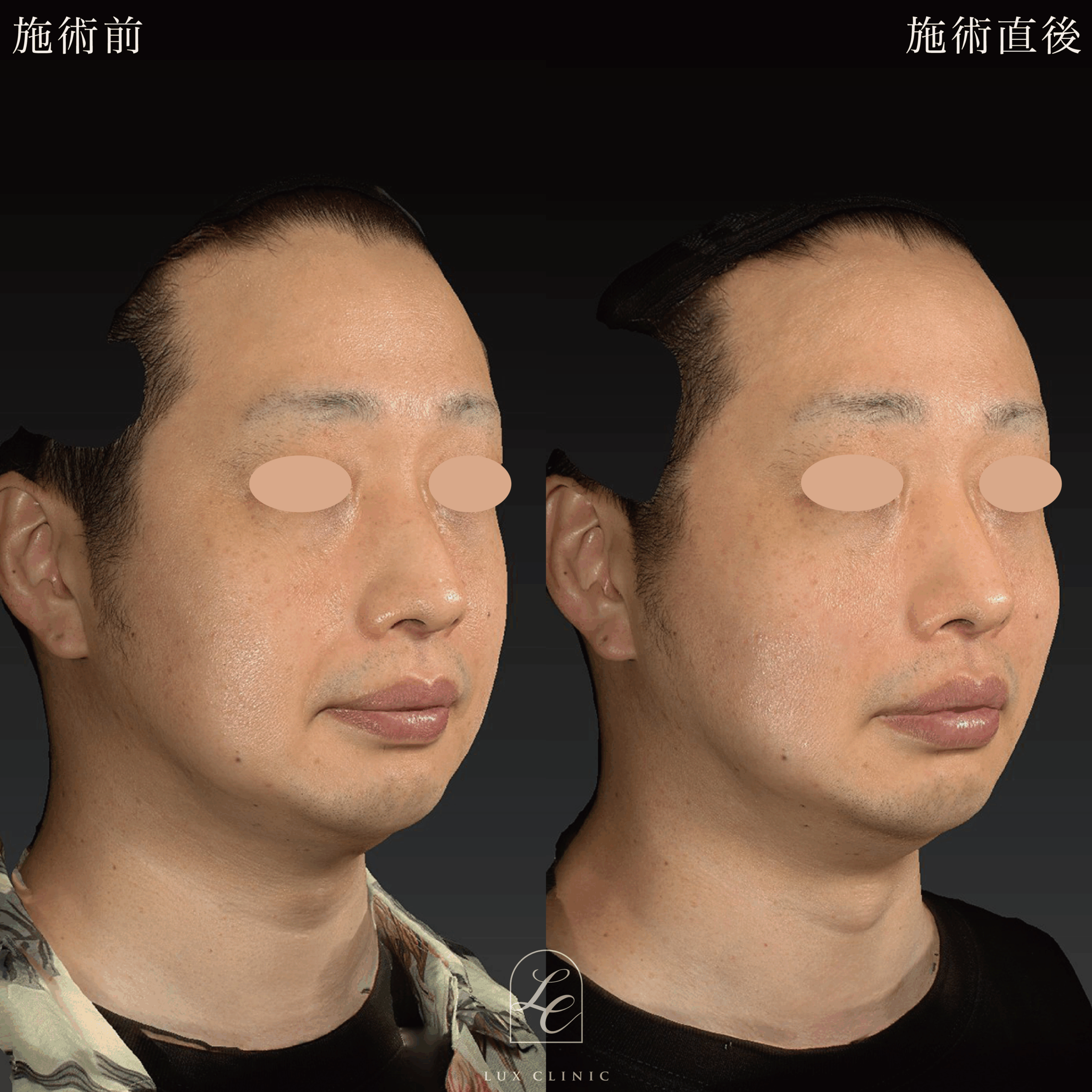 糸リフト(カクテルリフト 6本)