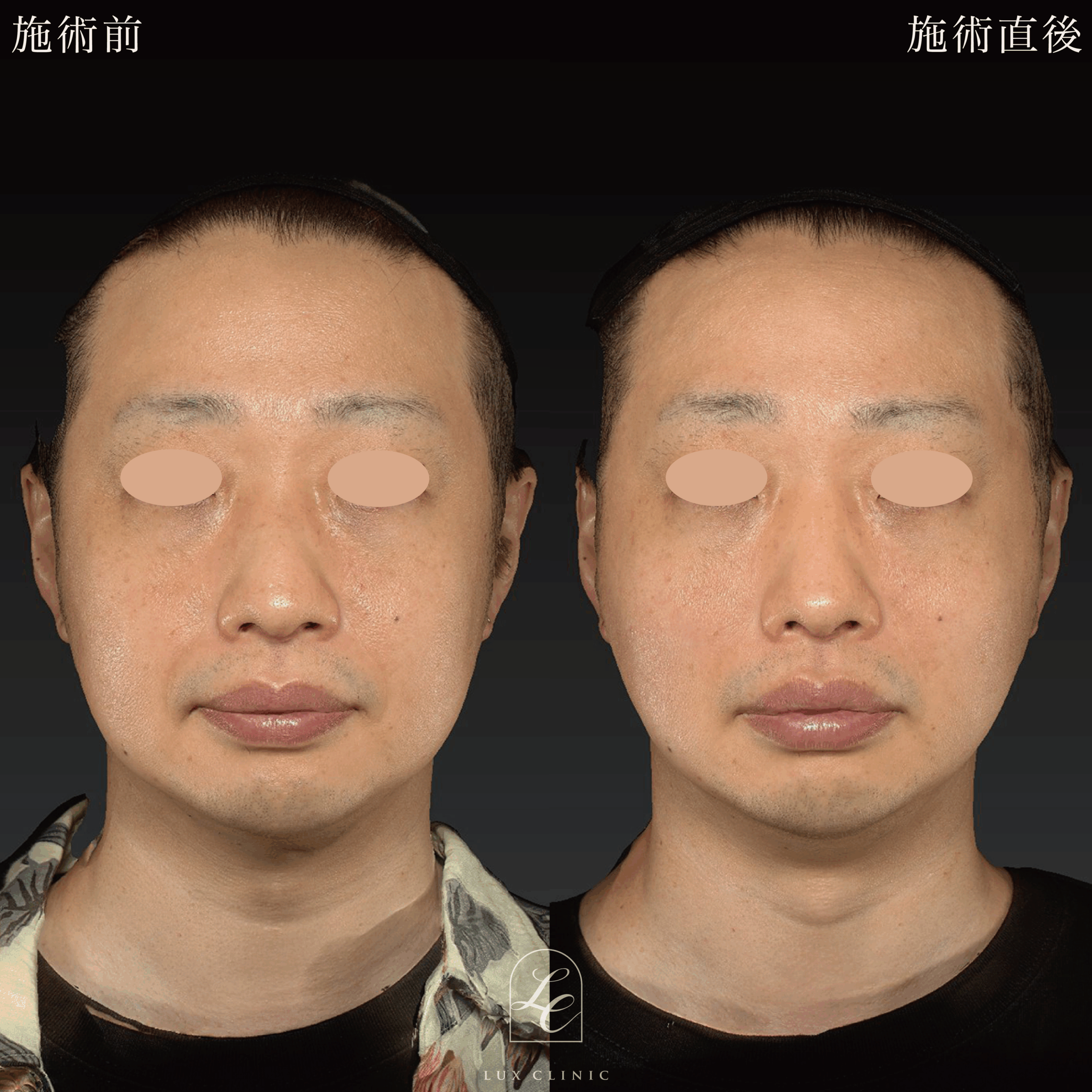 糸リフト(カクテルリフト 6本)