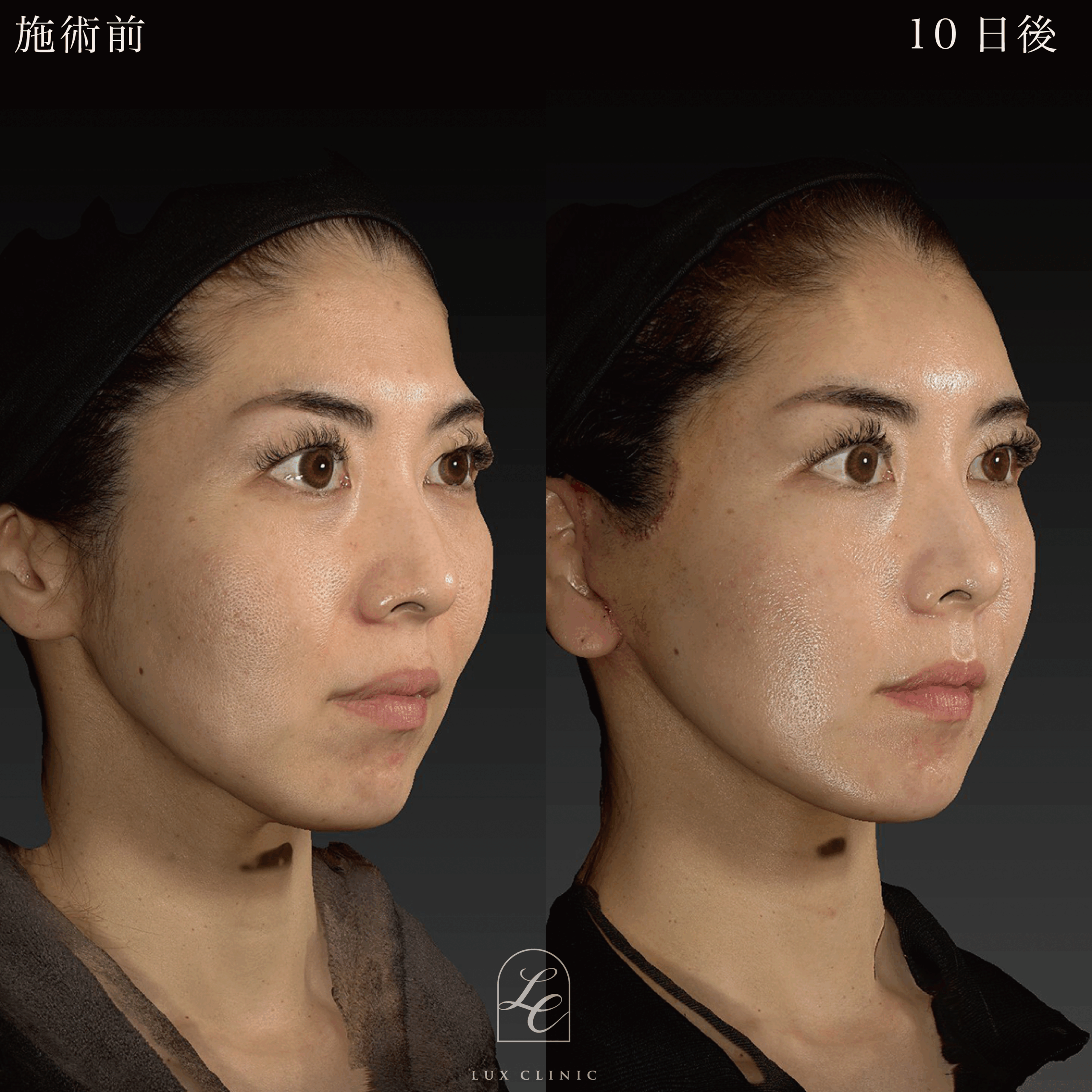 ミニフェイスリフト ＋ もみあげリフト ＋コンデンスリッチ脂肪注入 ＜顔全体・首＞ ※顔出しモニター