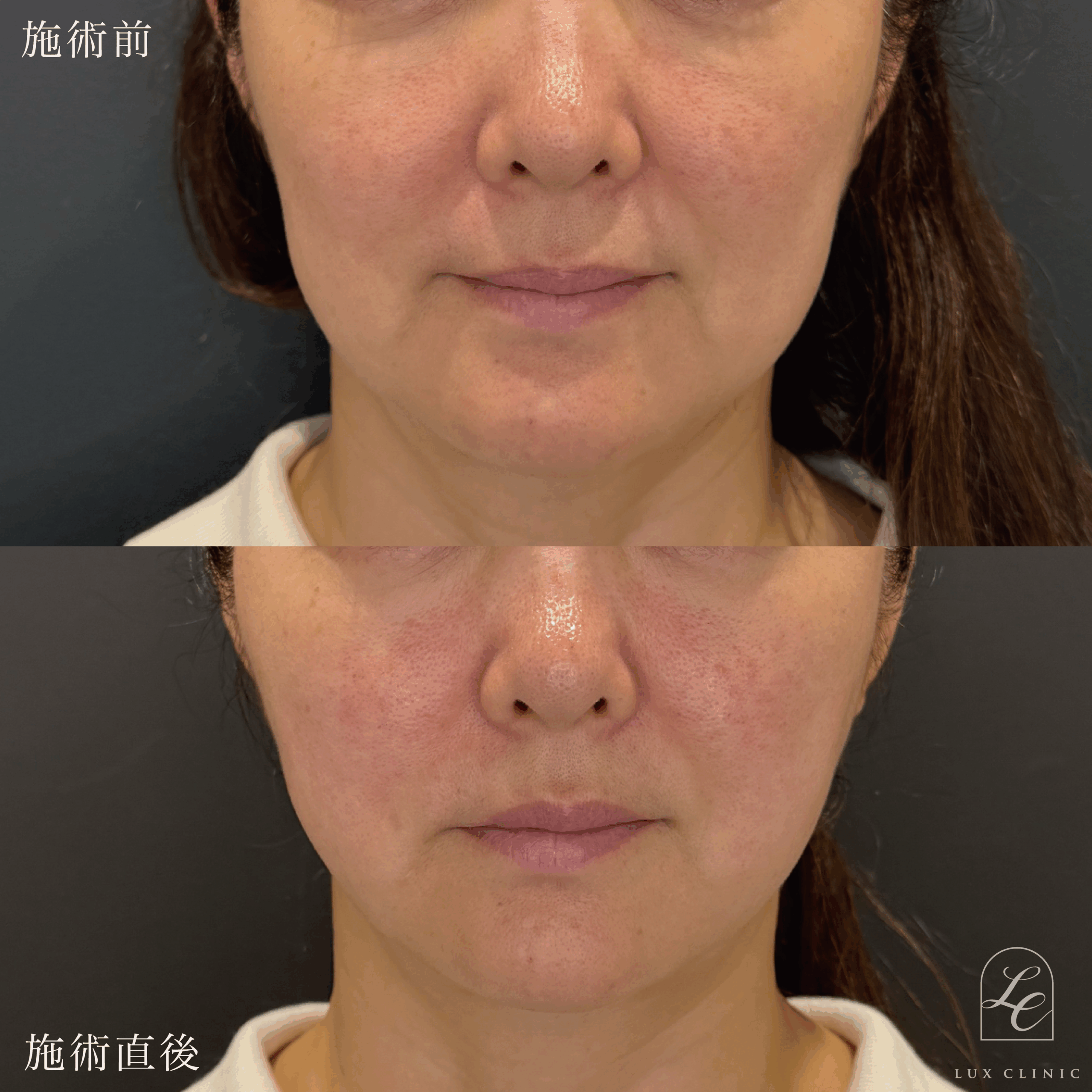 糸リフト（テスリフト 6本）