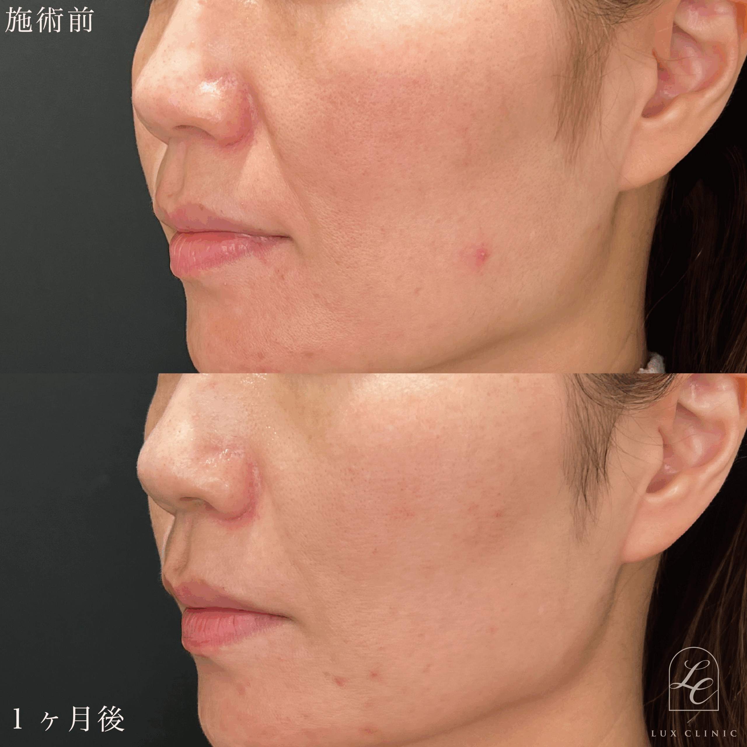 ヒアルロン酸（ジュビダームビスタボラックス0.6cc ボリフト0.2cc）＜鼻翼基部・ほうれい線＞