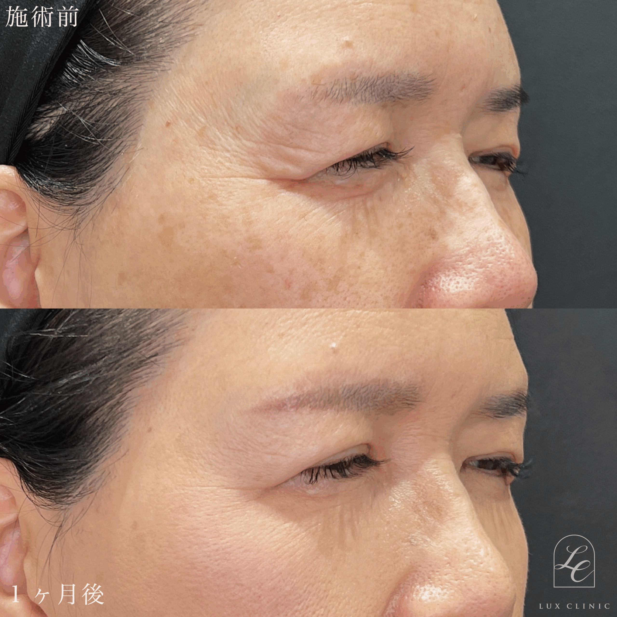 ボトックスビスタ（アラガン社製）目尻