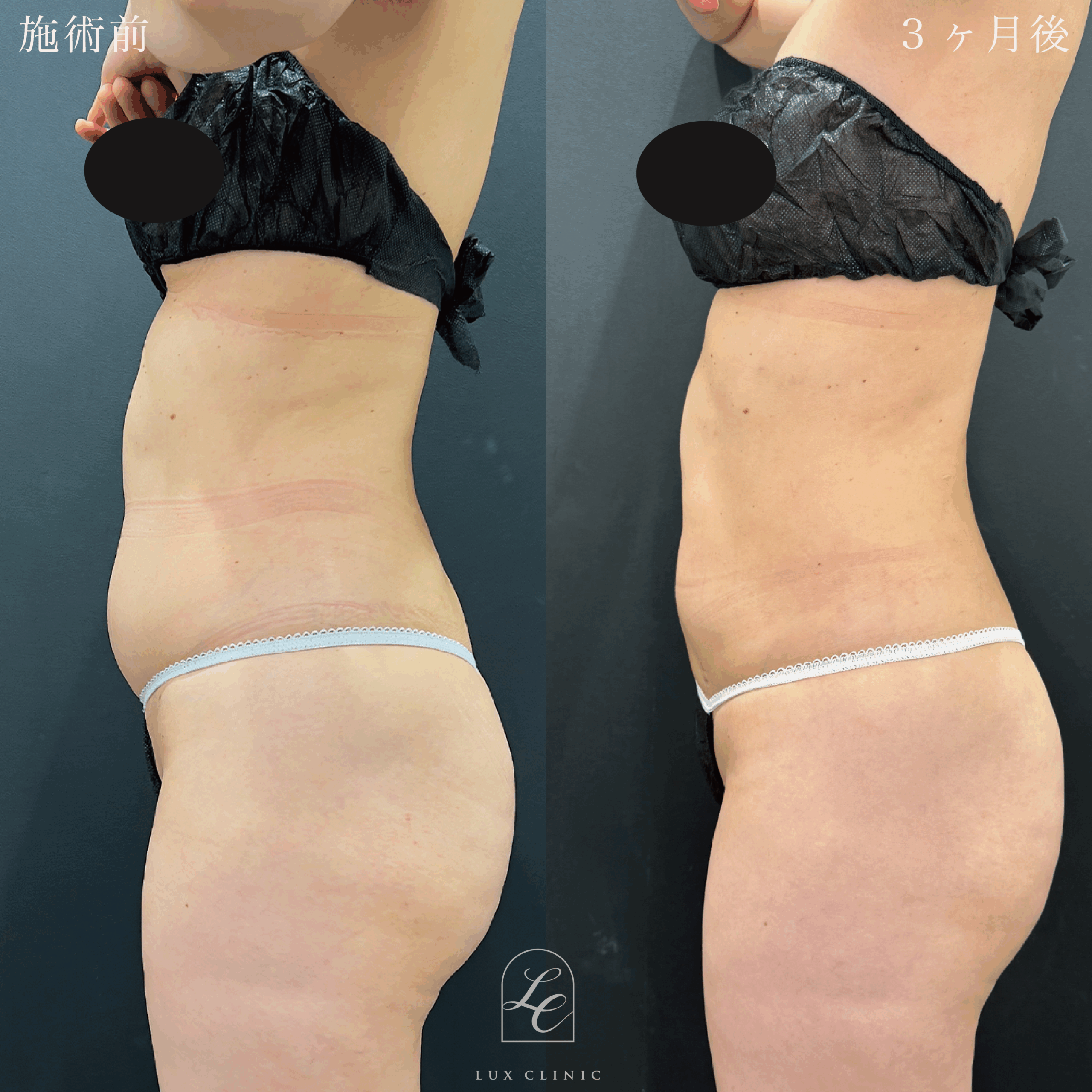 Ultra-Z 脂肪吸引 ＜腹部前面（上・下）・脇腹（前・後）・腰＞