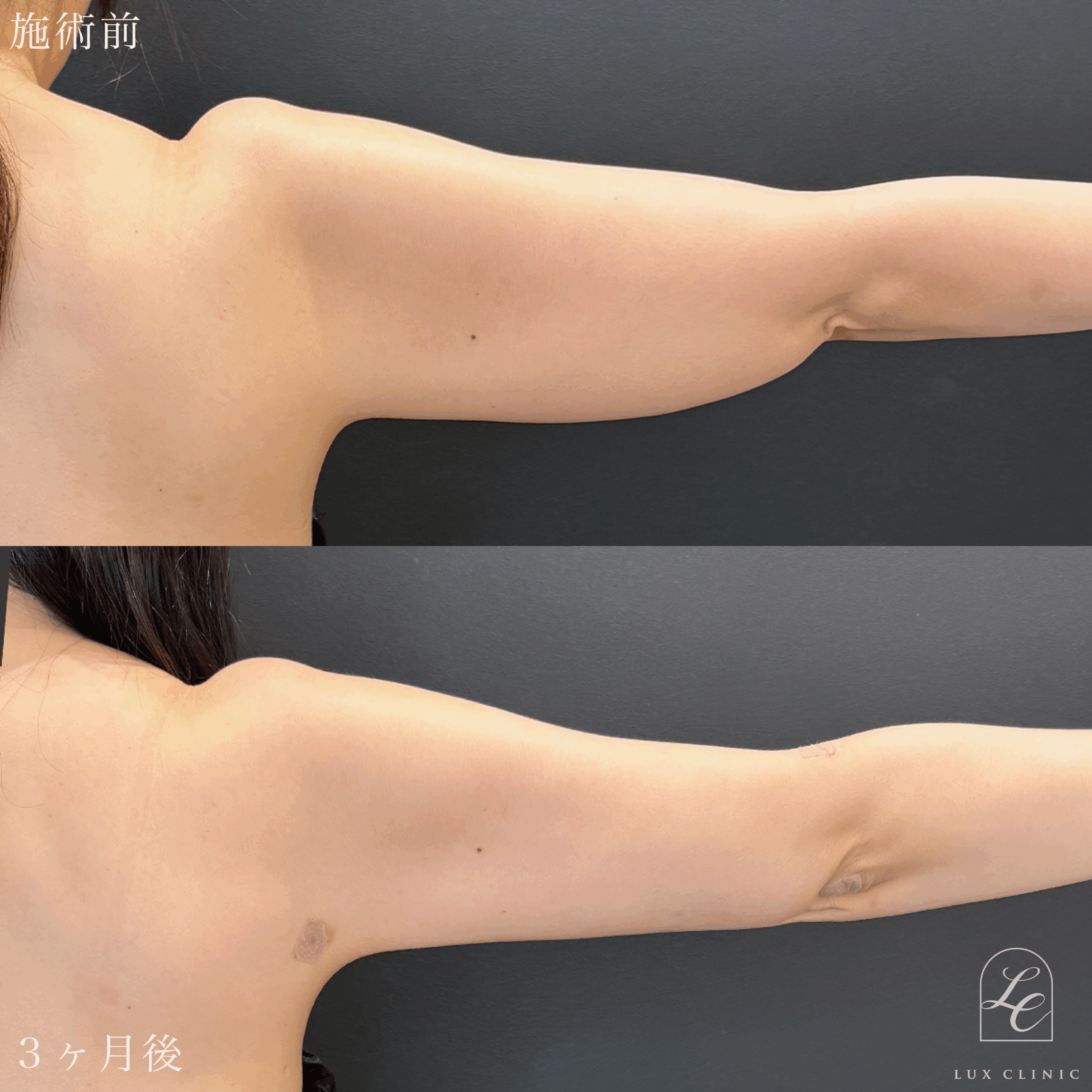 Ultra-Z 脂肪吸引 ＜二の腕（全周）・肩・肩甲骨横＞