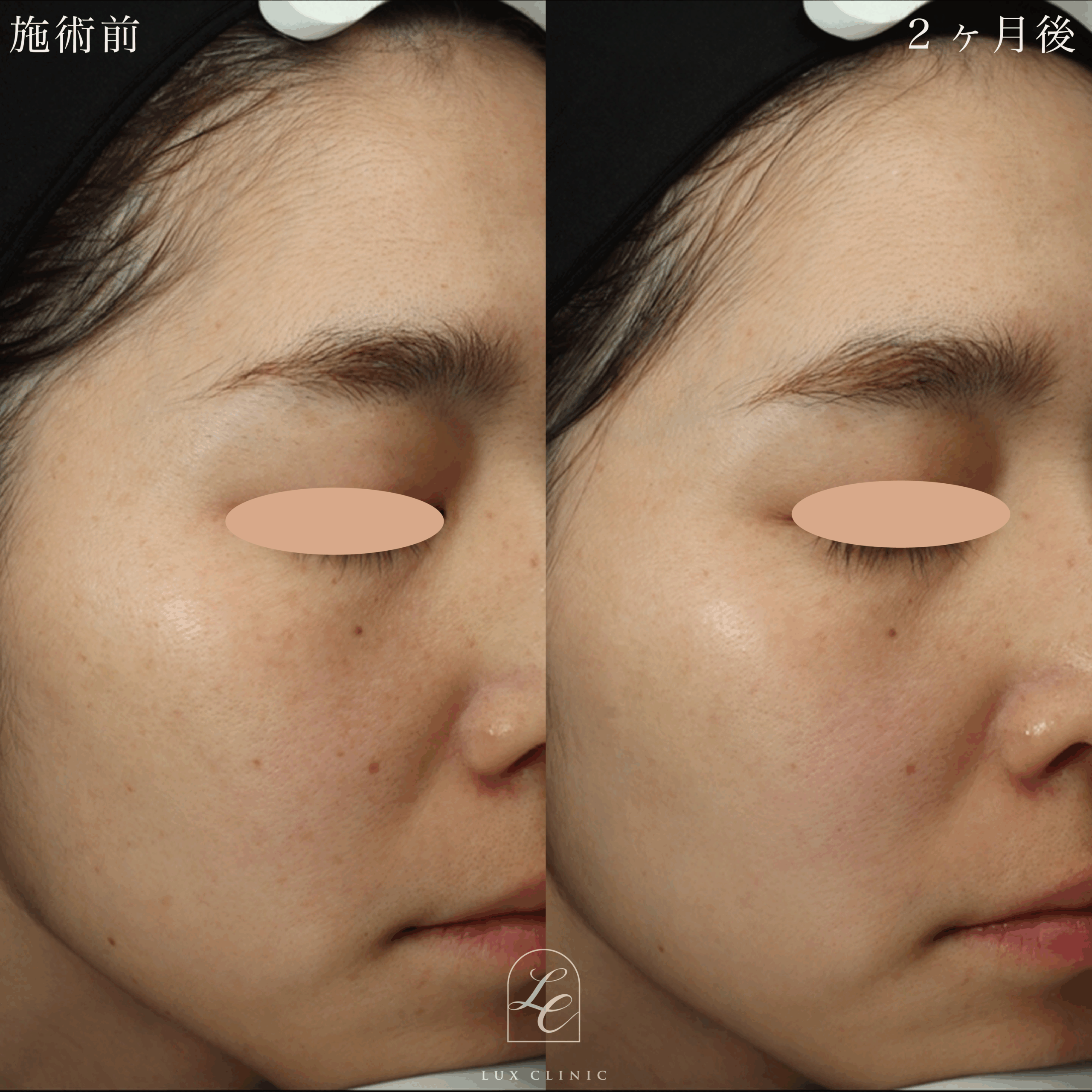 ディスカバリーピコプラス ルビーフラクショナル＜顔全体＞1回