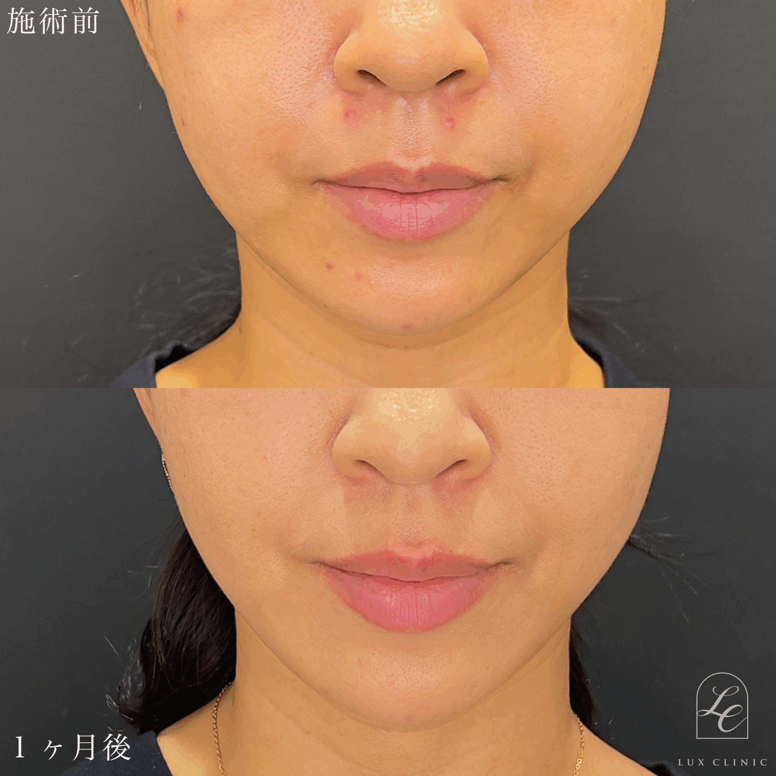 ヒアルロン酸（レスチレン2本）＜口角＞