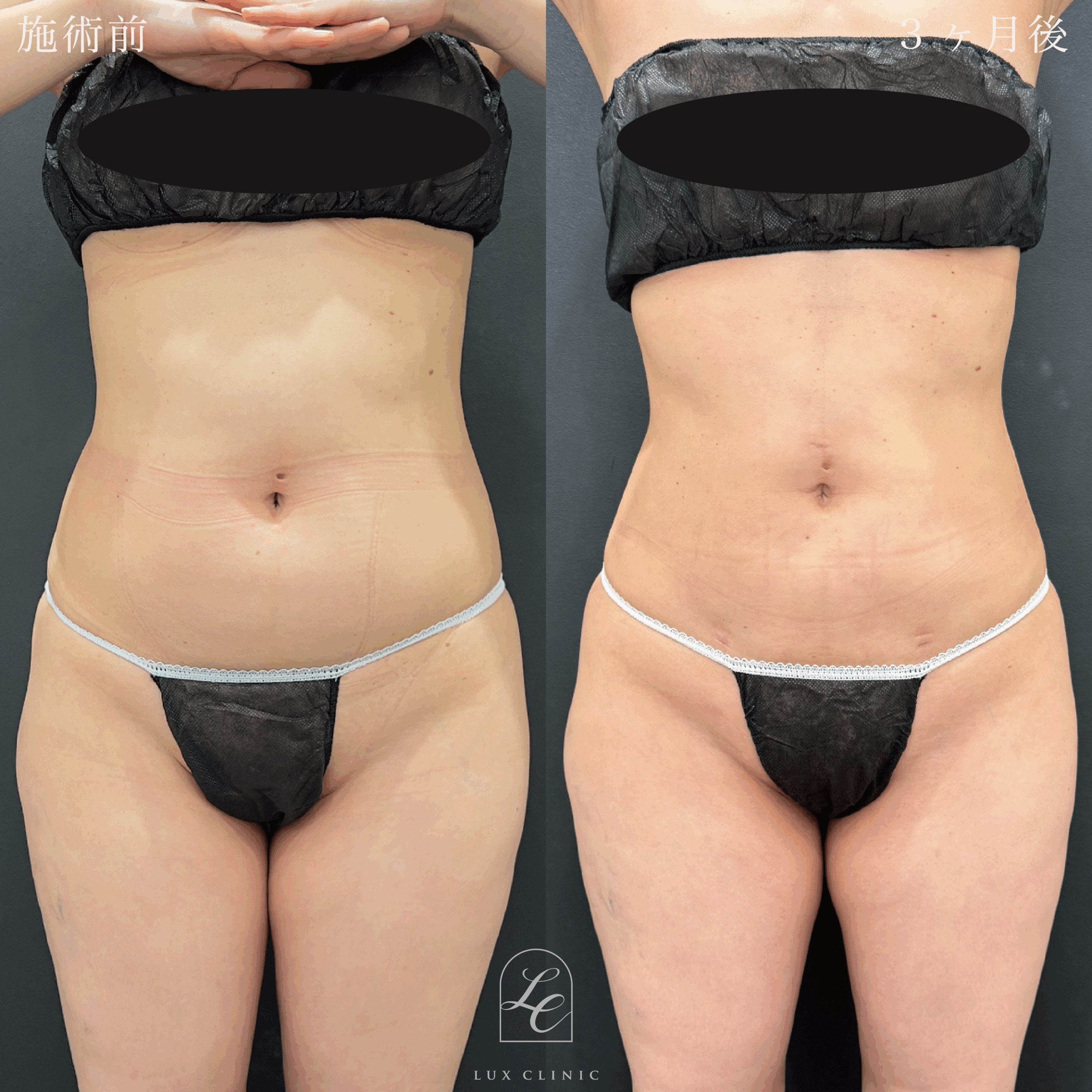 Ultra-Z 脂肪吸引 ＜腹部前面（上・下）・脇腹（前・後）・腰＞