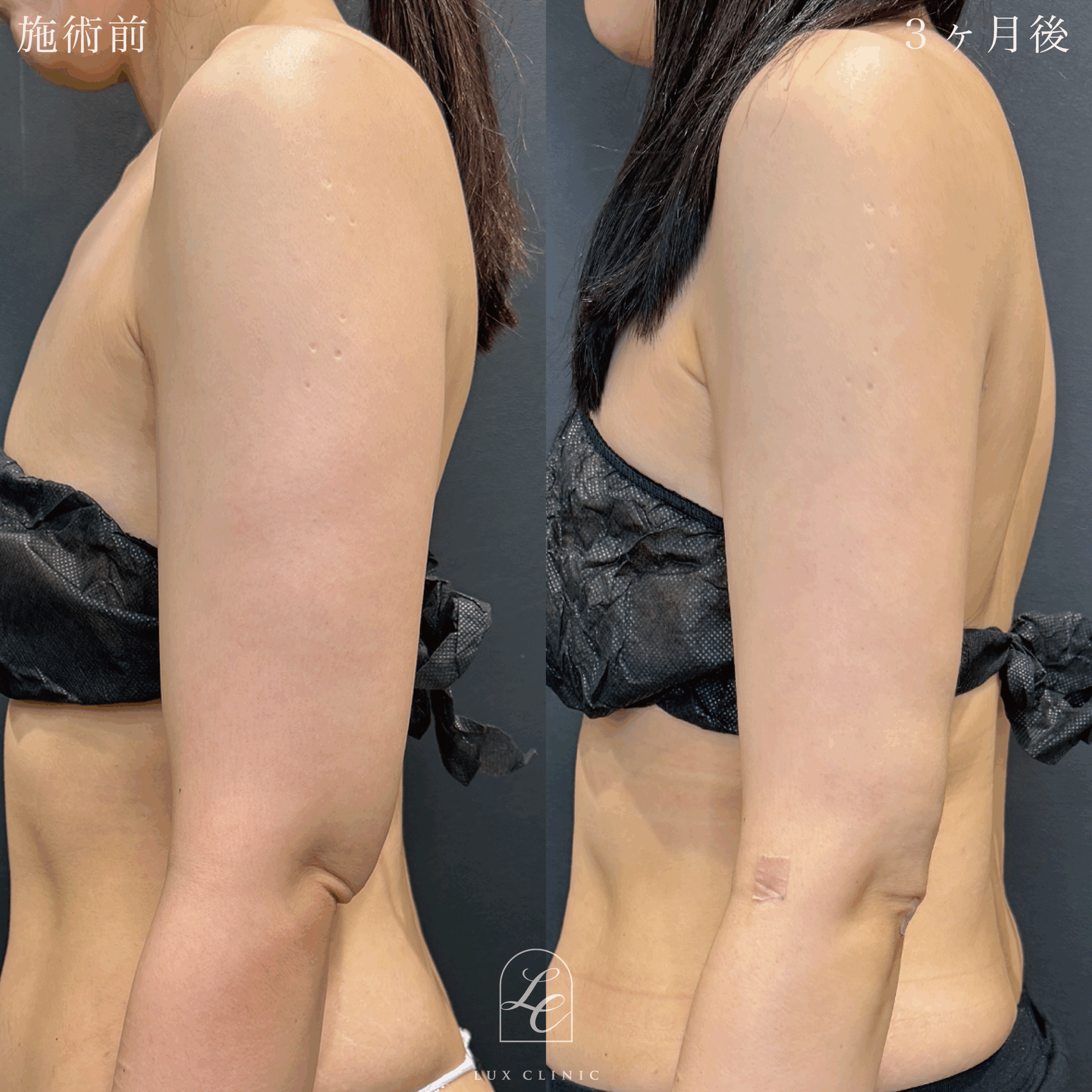 Ultra-Z 脂肪吸引 ＜二の腕（全周）・肩・肩甲骨横＞