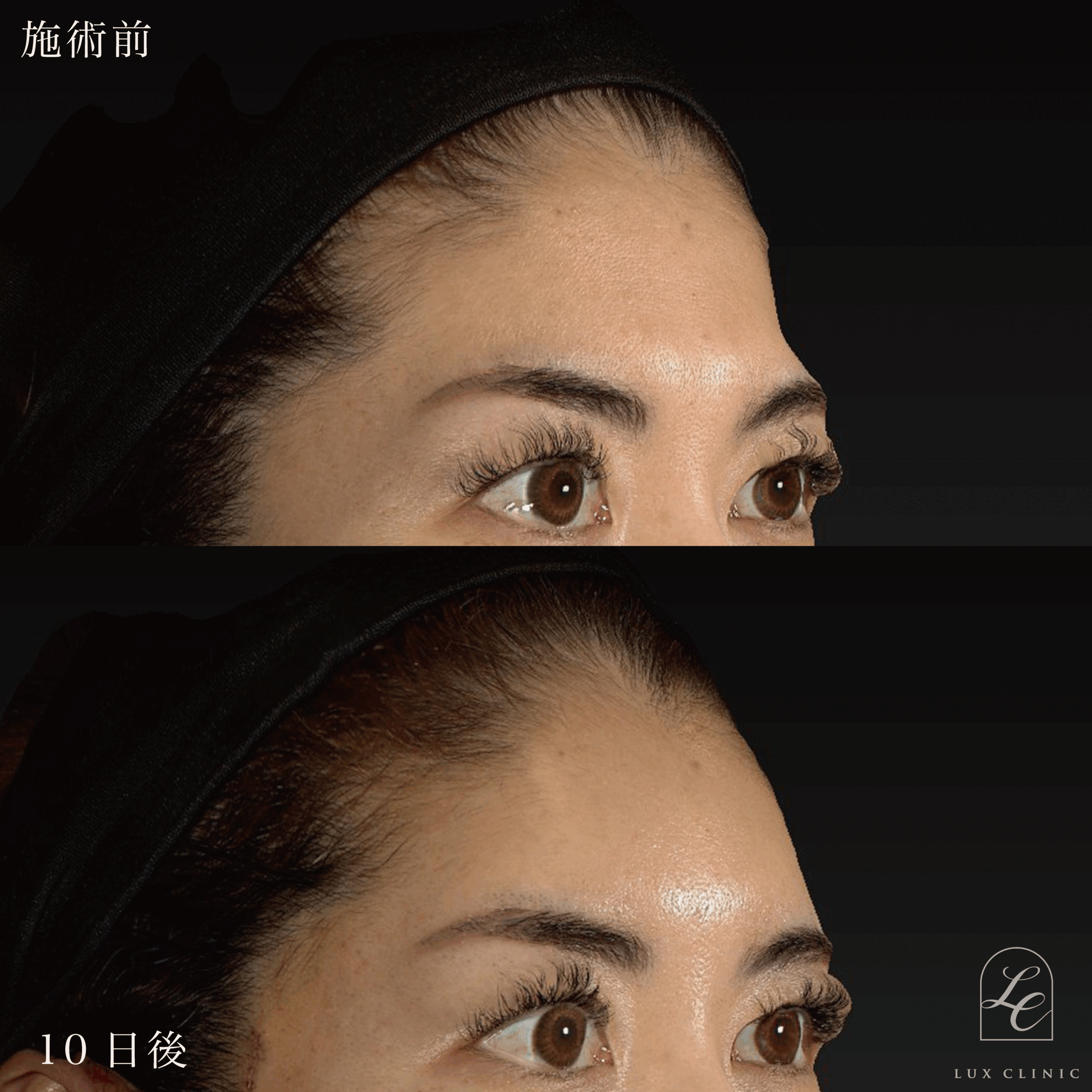 ミニフェイスリフト ＋ もみあげリフト ＋コンデンスリッチ脂肪注入 ＜顔全体・首＞ ※顔出しモニター