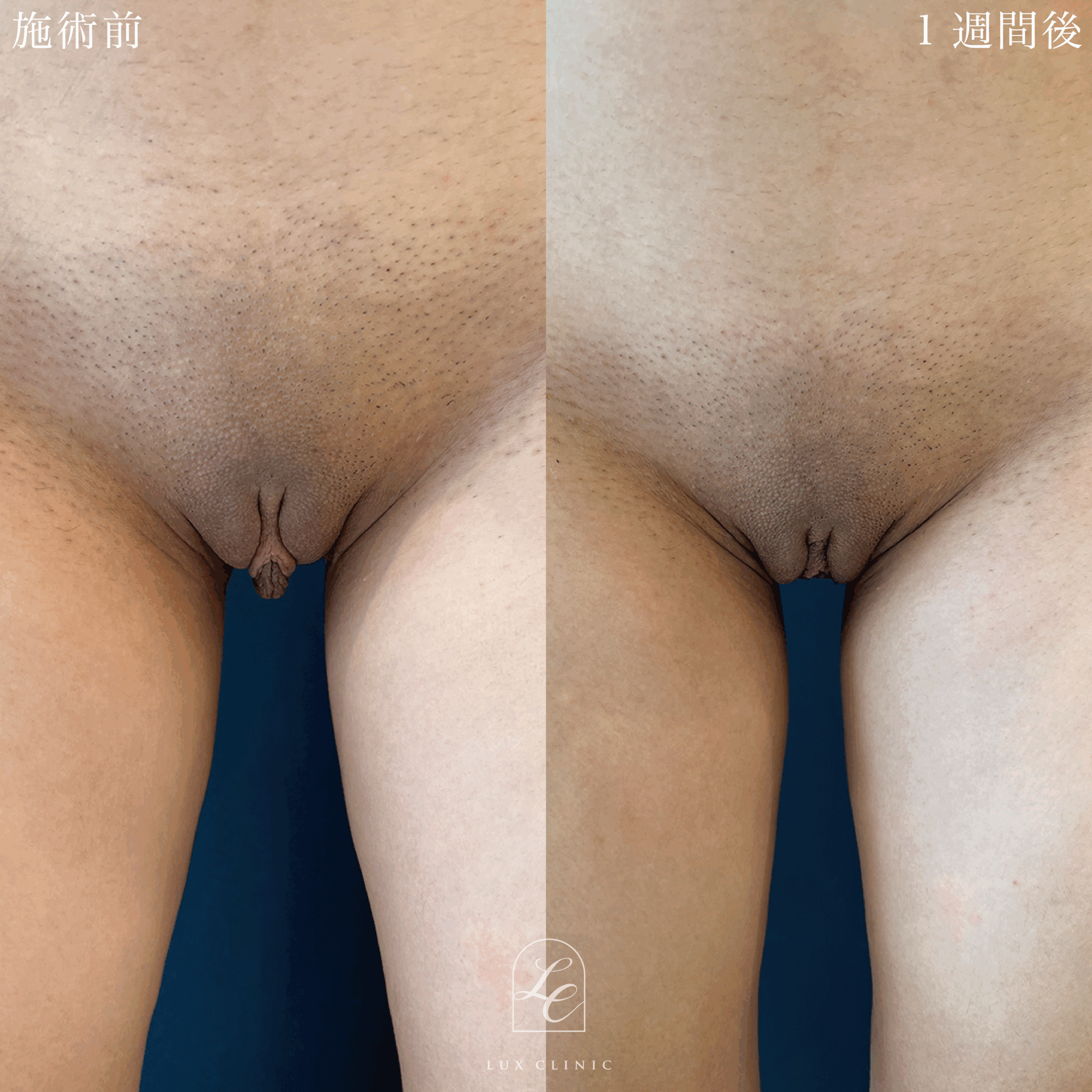 小陰唇縮小術インスィーム法（抜糸なし） ＋ 副皮副皮切除術 インスィーム法（抜糸なし）