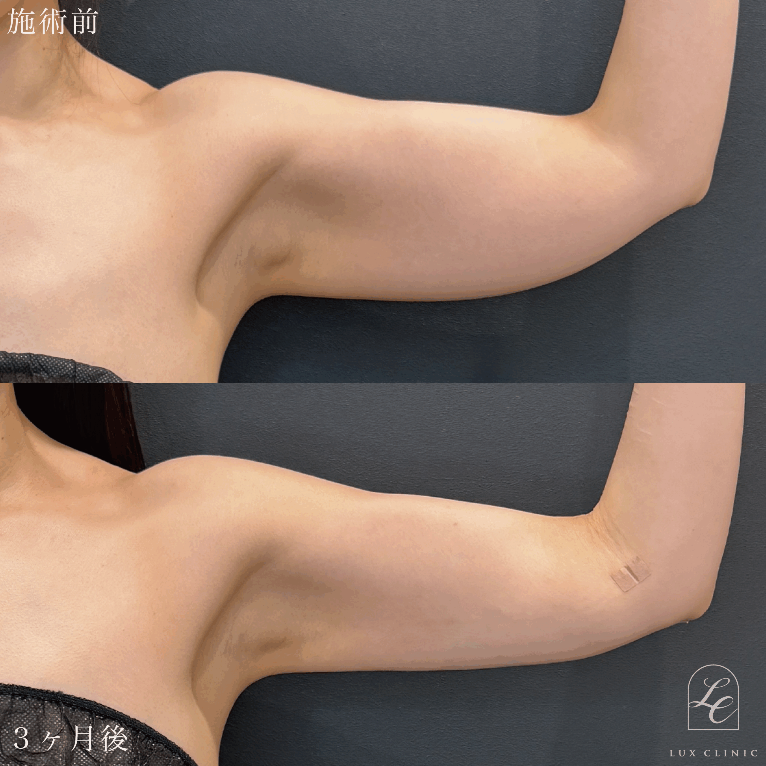 Ultra-Z 脂肪吸引 ＜二の腕（全周）・肩・肩甲骨横＞