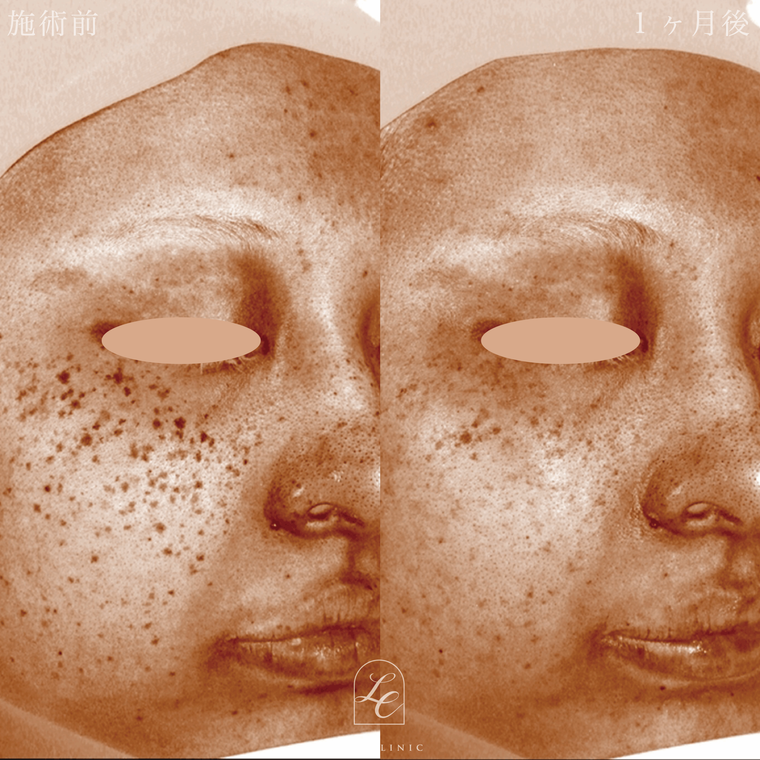 ディスカバリーピコプラス しみスポット照射＜顔全体＞1回