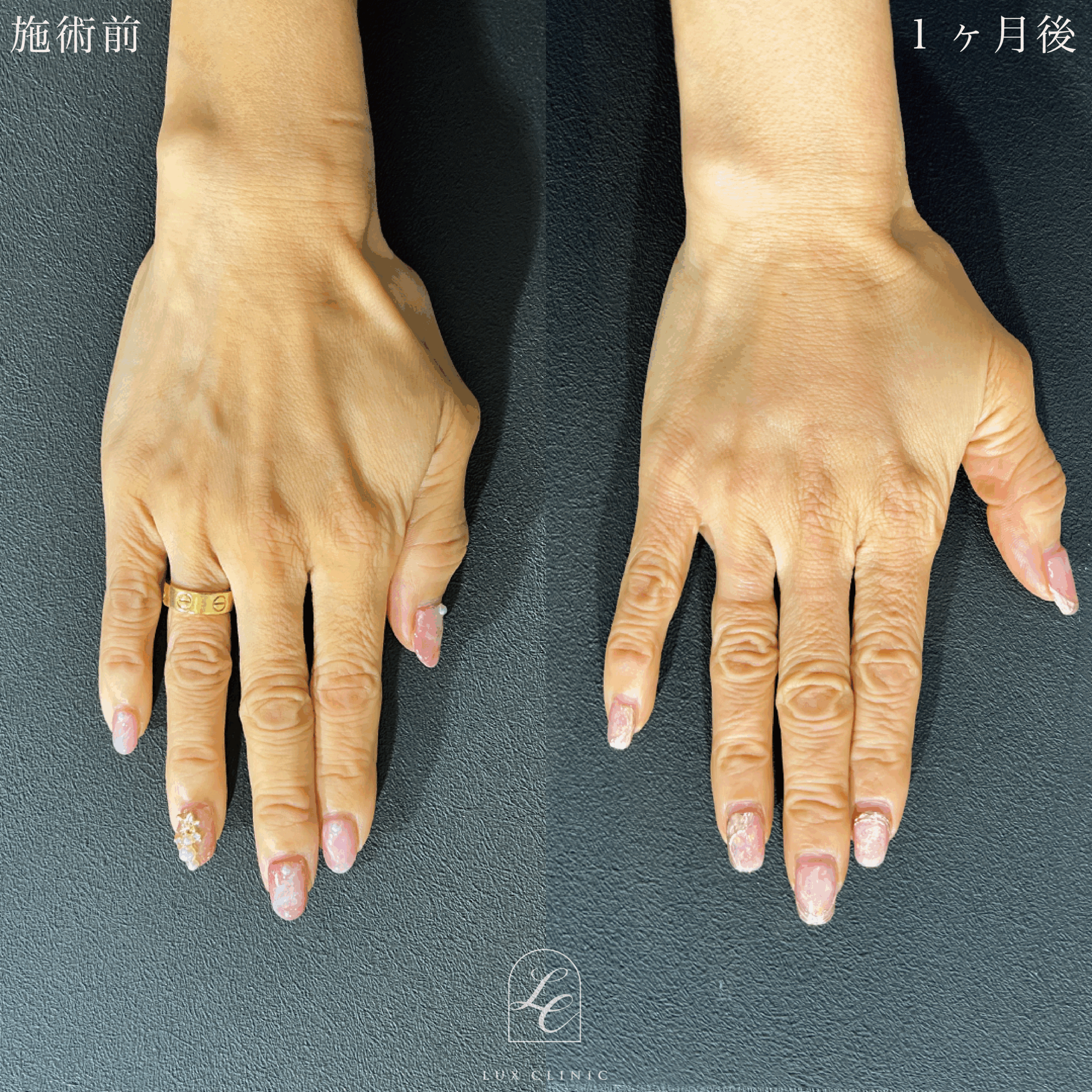 ヒアルロン酸（ジュビダームビスタ ボリフト1,3cc）＜手の甲＞