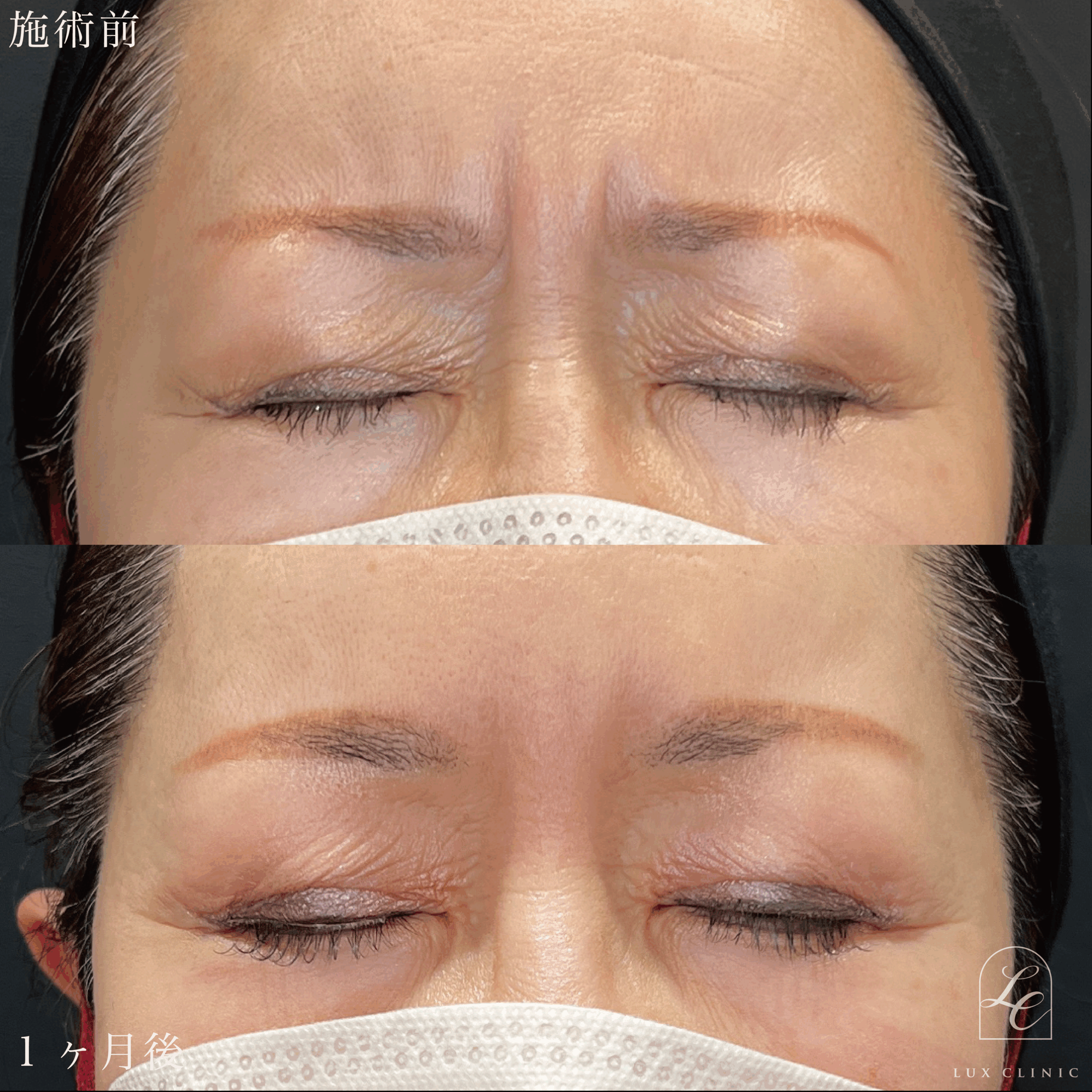 ボトックスビスタ（アラガン社製）眉間