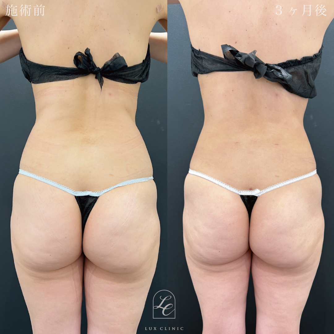 Ultra-Z 脂肪吸引 ＜腹部前面（上・下）・脇腹（前・後）・腰＞