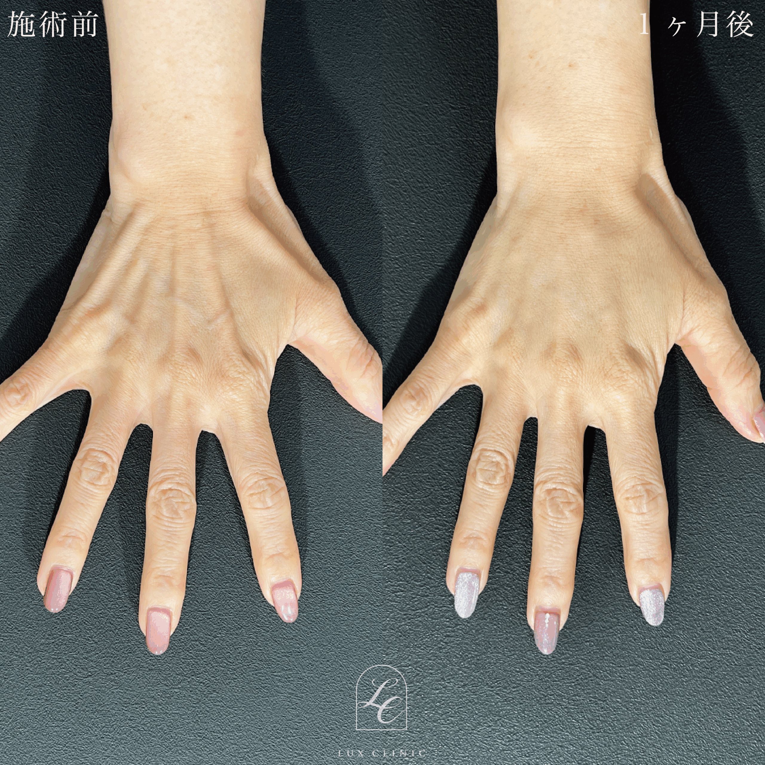 ヒアルロン酸（レスチレン3本）＜手の甲＞