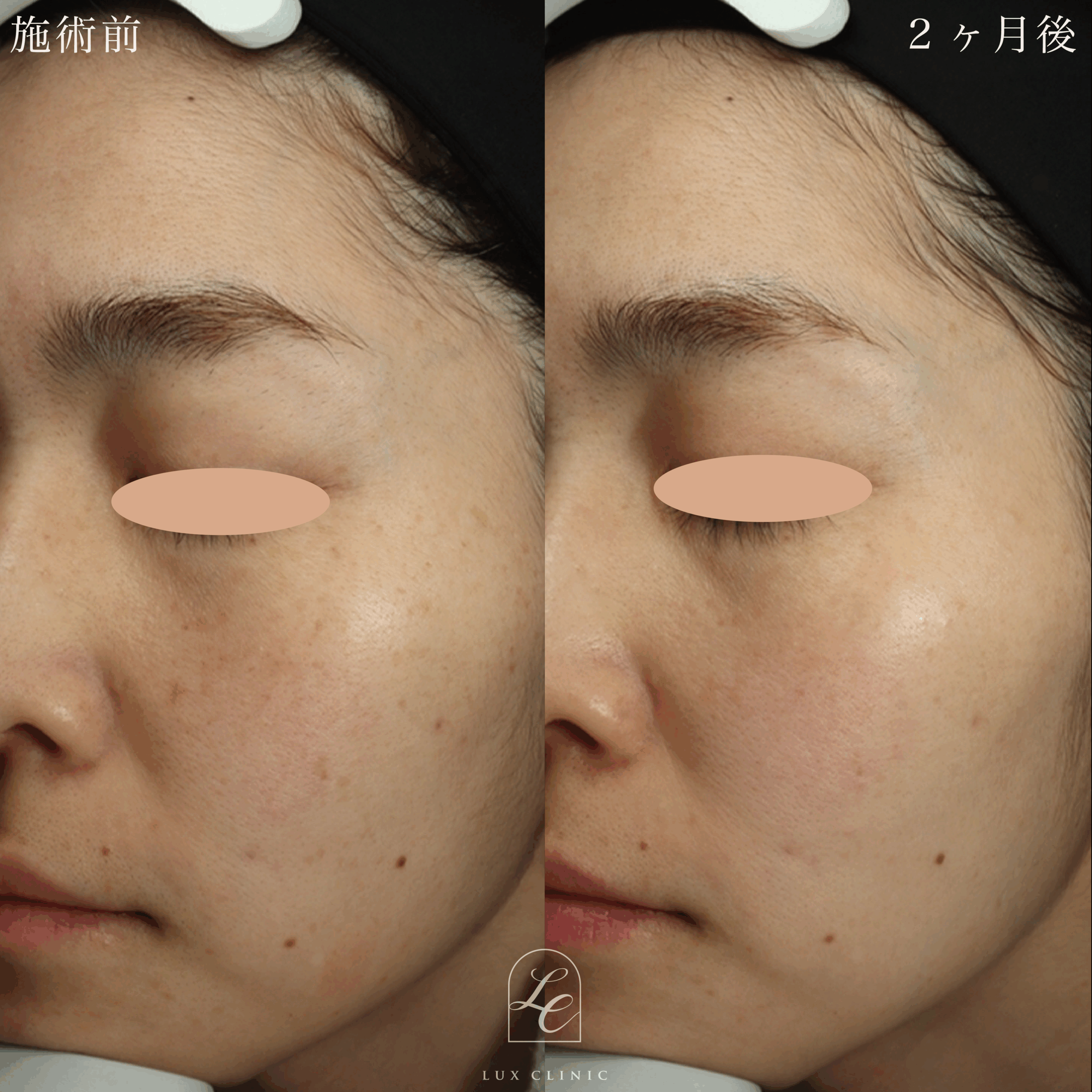 ディスカバリーピコプラス ルビーフラクショナル＜顔全体＞1回