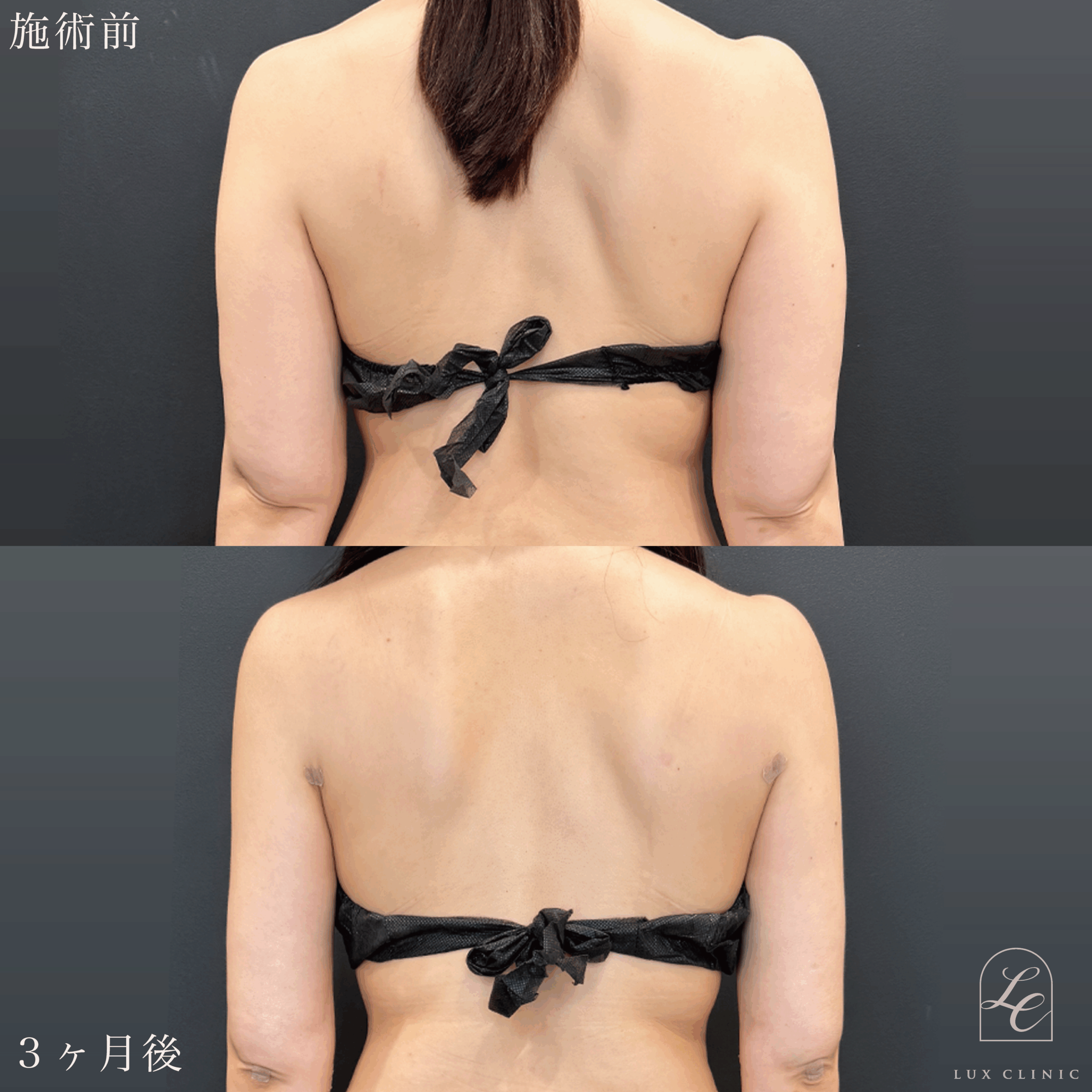 Ultra-Z 脂肪吸引 ＜二の腕（全周）・肩・肩甲骨横＞