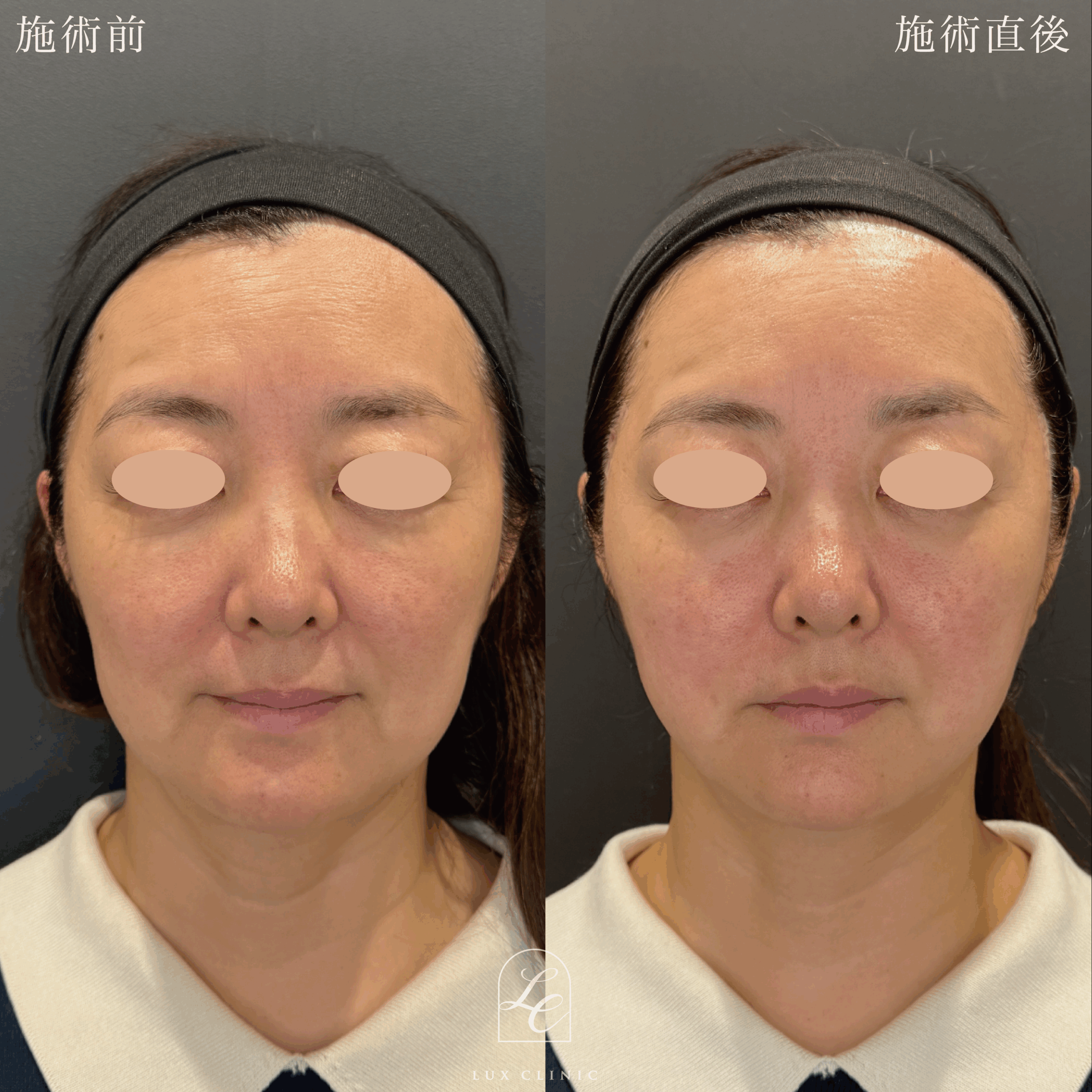 糸リフト（テスリフト 6本）