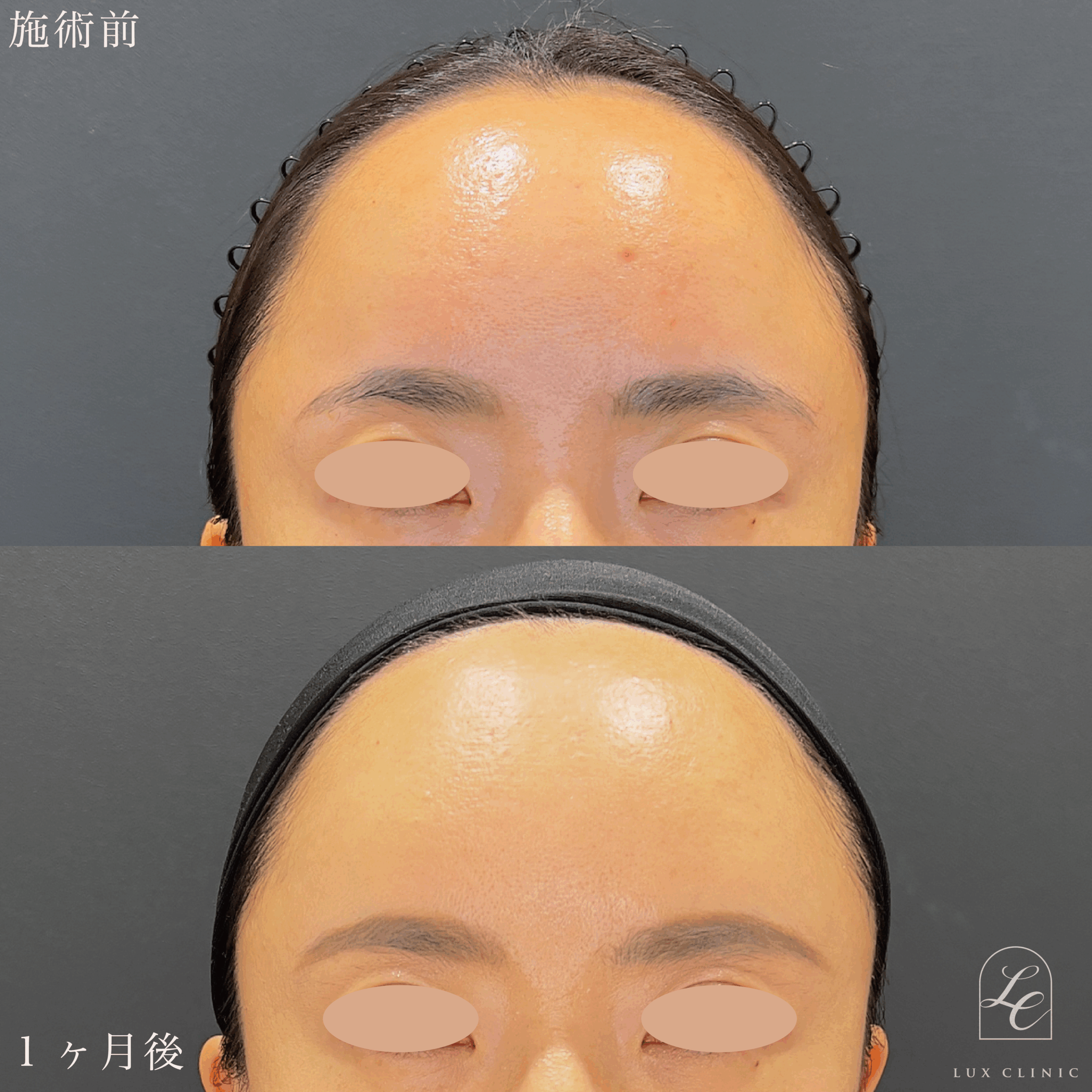 ヒアルロン酸（レスチレン4本）＜額・こめかみ＞