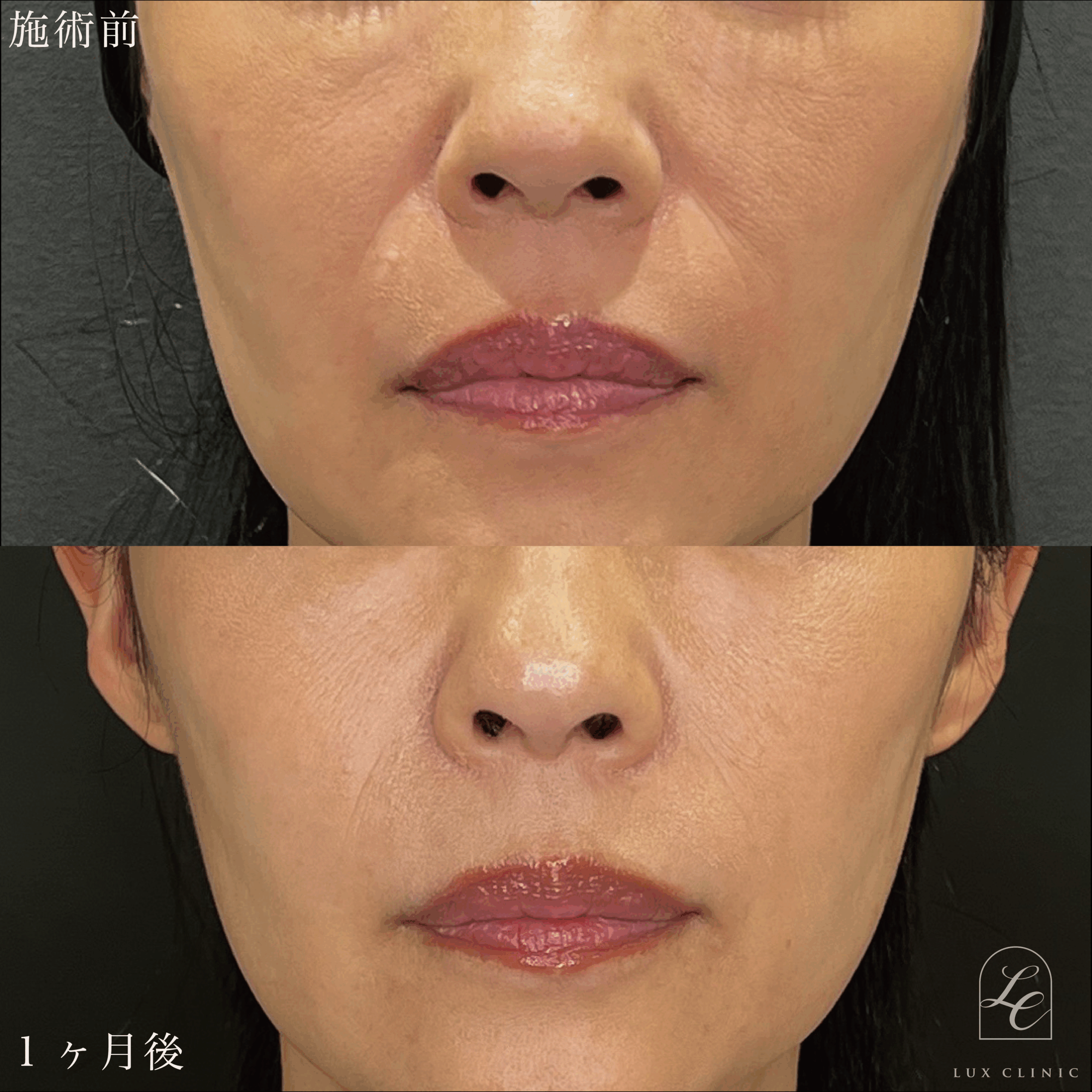 ヒアルロン酸（ジュビダームビスタ ボラックス1本）＜鼻翼基部＞