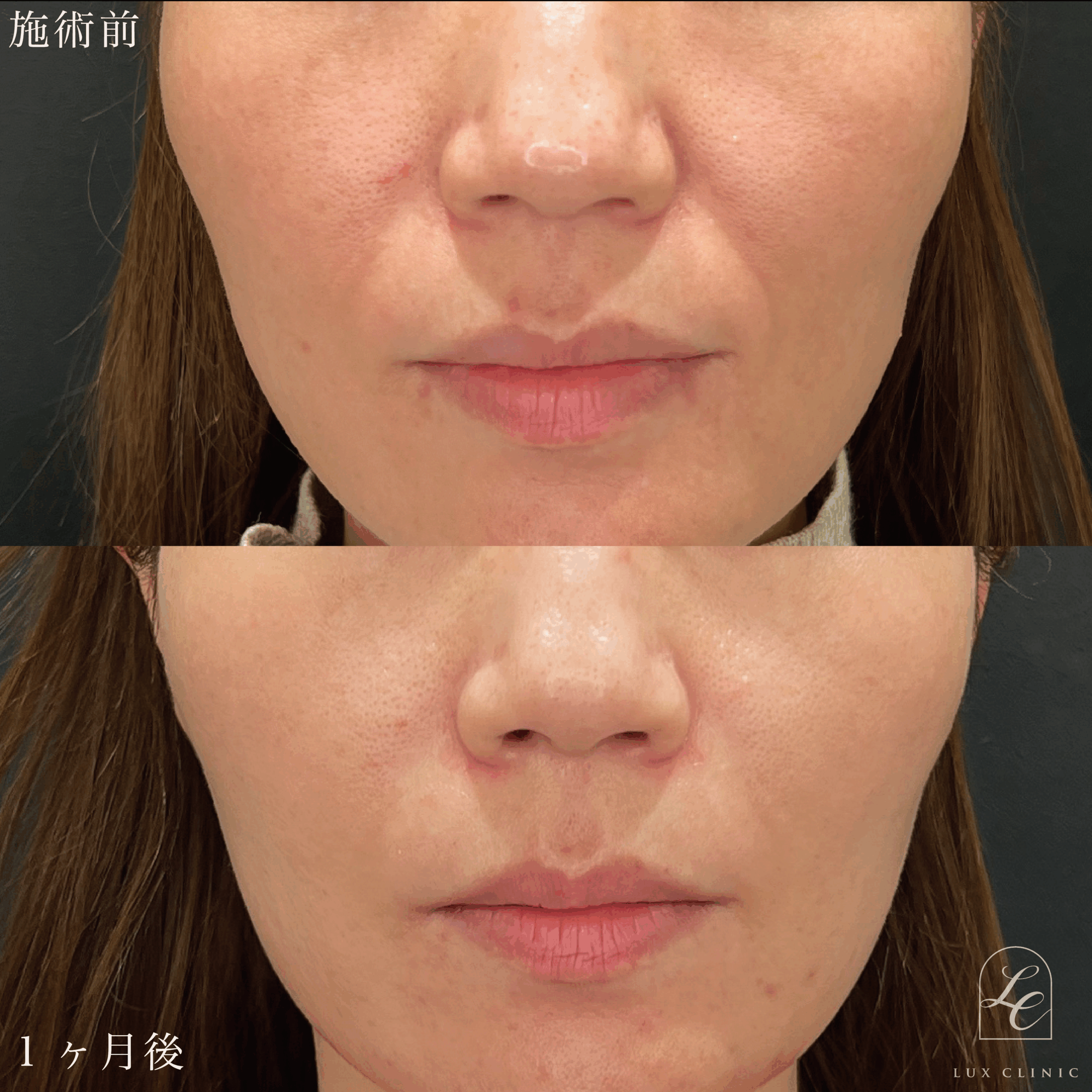 ヒアルロン酸（ジュビダームビスタボラックス0.6cc ボリフト0.2cc）＜鼻翼基部・ほうれい線＞