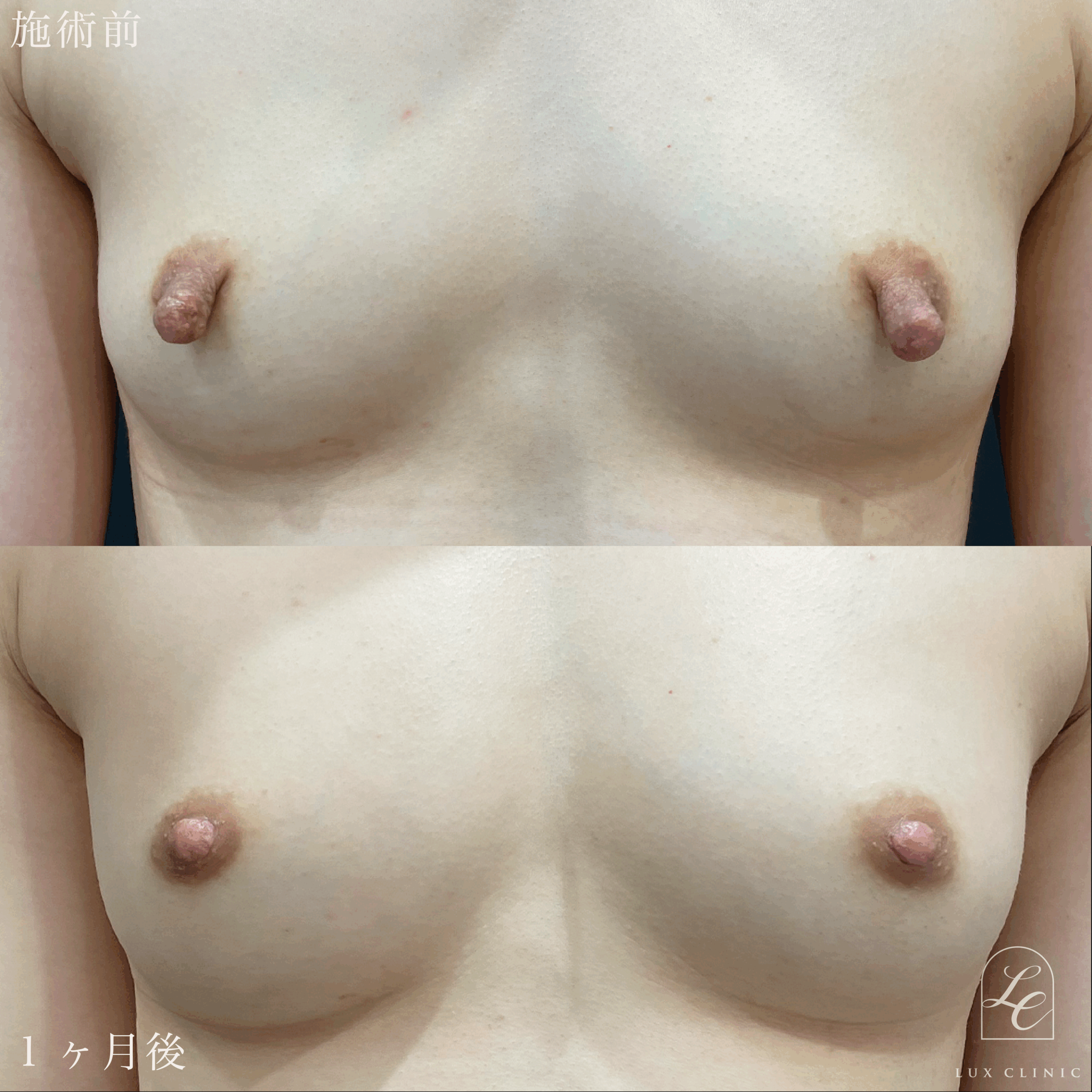 乳頭縮小術（乳管温存あり）