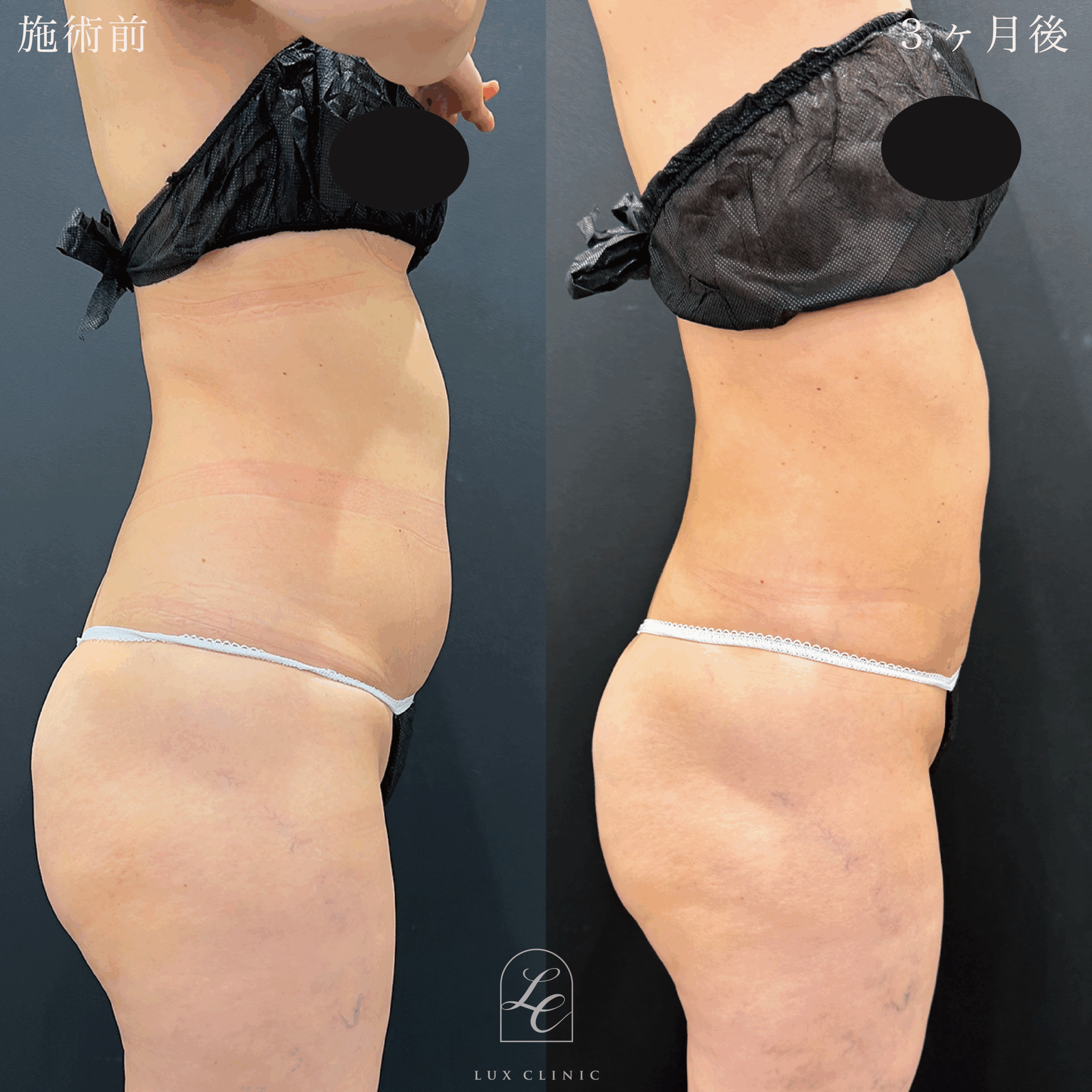 Ultra-Z 脂肪吸引 ＜腹部前面（上・下）・脇腹（前・後）・腰＞