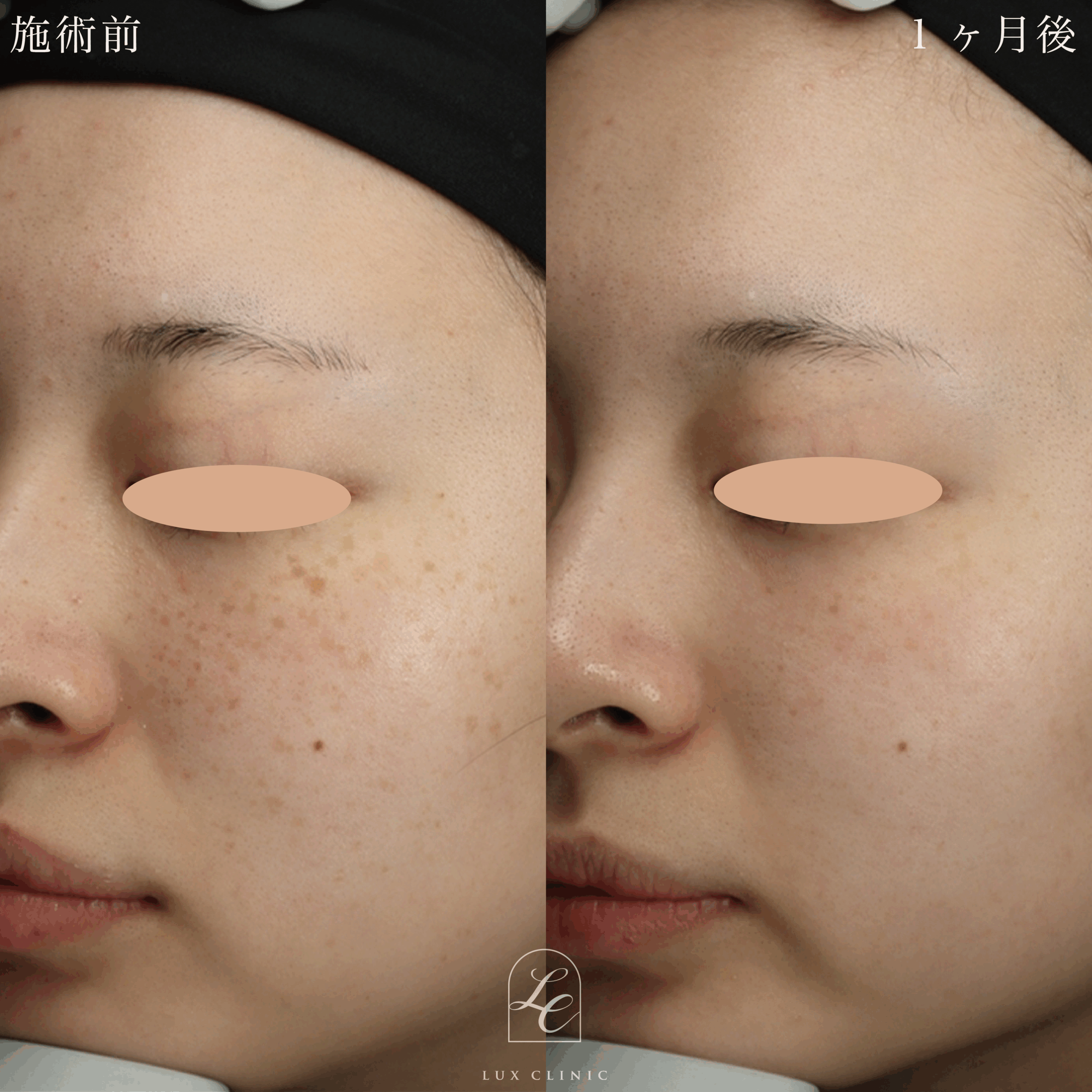 ディスカバリーピコプラス しみスポット照射＜顔全体＞1回