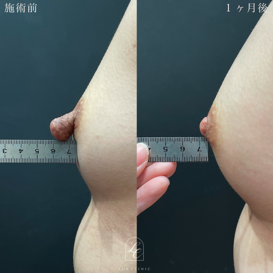 乳頭縮小術(乳管温存あり)